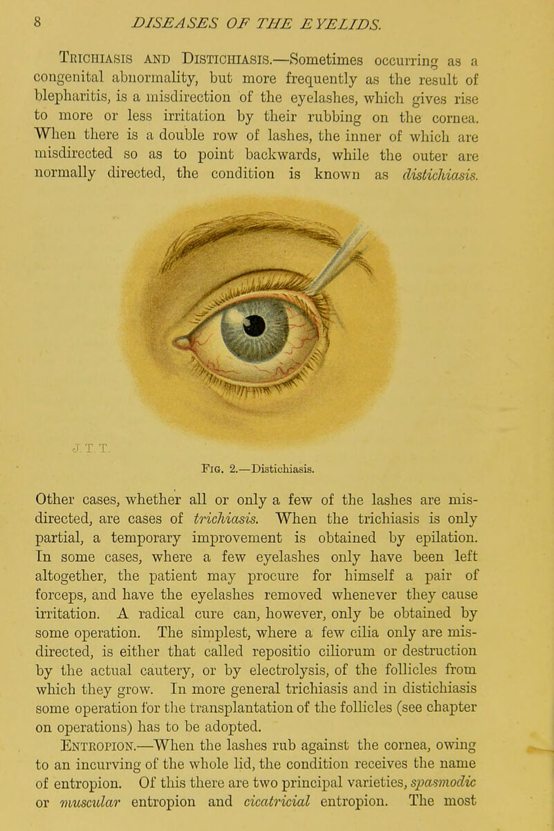 Teichiasis and Distichiasis.—Sometimes occurring as a congenital abnormality, but more frequently as the result of blepharitis, is a misdirection of the eyelashes, which gives rise to more or less irritation by their rubbing on the cornea. When there is a double row of lashes, the inner of which are misdirected so as to point backwards, while the outer are normally directed, the condition is known as distichiasis. S J. T T. Pig, 2.—Distichiasis. Other cases, whether all or only a few of the lashes are mis- directed, are cases of trichiasis. When the trichiasis is only partial, a temporary improvement is obtained by epilation. In some cases, where a few eyelashes only have been left altogether, the patient may procure for himself a pair of forceps, and have the eyelashes removed whenever they cause irritation. A radical cure can, however, only be obtained by some operation. The simplest, where a few cilia only are mis- directed, is either that called repositio ciliorum or destruction by the actual cautery, or by electrolysis, of the follicles from which they grow. In more general trichiasis and in distichiasis some operation for the transplantation of the follicles (see chapter on operations) has to be adopted. Enteopion.—When the lashes rub against the cornea, owing to an incurving of the whole lid, the condition receives the name of entropion. Of this there are two principal varieties, spasmodic or muscular entropion and cicatricial entropion. The most