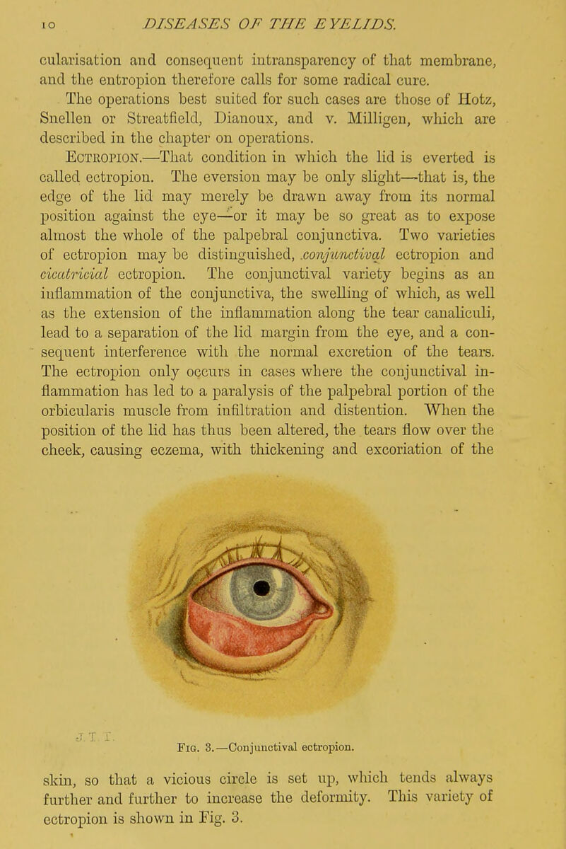 cularisation and consequent iutransparency of that membrane, and the entropion therefore calls for some radical cure. The operations best suited for such cases are those of Hotz, Snellen or Streatfield, Dianoux, and v. Milligen, which are described in the chapter on operations. Ectropion.—That condition in which the lid is everted is called ectropion. The eversion may be only slight—that is, the edge of the lid may merely be drawn away from its normal position against the eye—or it may be so great as to expose almost the whole of the palpebral conjunctiva. Two varieties of ectropion may be distinguished, .conjunctival ectropion and cicatricial ectropion. The conjunctival variety begins as an inflammation of the conjunctiva, the swelling of which, as well as the extension of the inflammation along the tear canaliculi, lead to a separation of the lid margin from the eye, and a con- sequent interference with the normal excretion of the tears. The ectropion only occurs in cases where the conjunctival in- flammation has led to a paralysis of the palpebral portion of the orbicularis muscle from infiltration and distention. When the position of the lid has thus been altered, the tears flow over the cheek, causing eczema, with thickening and excoriation of the Fig. 3.—Conjunctival ectropion. skin, SO that a vicious circle is set up, wliich tends always further and further to increase the deformity. This variety of ectropion is shown in Fig. 3.