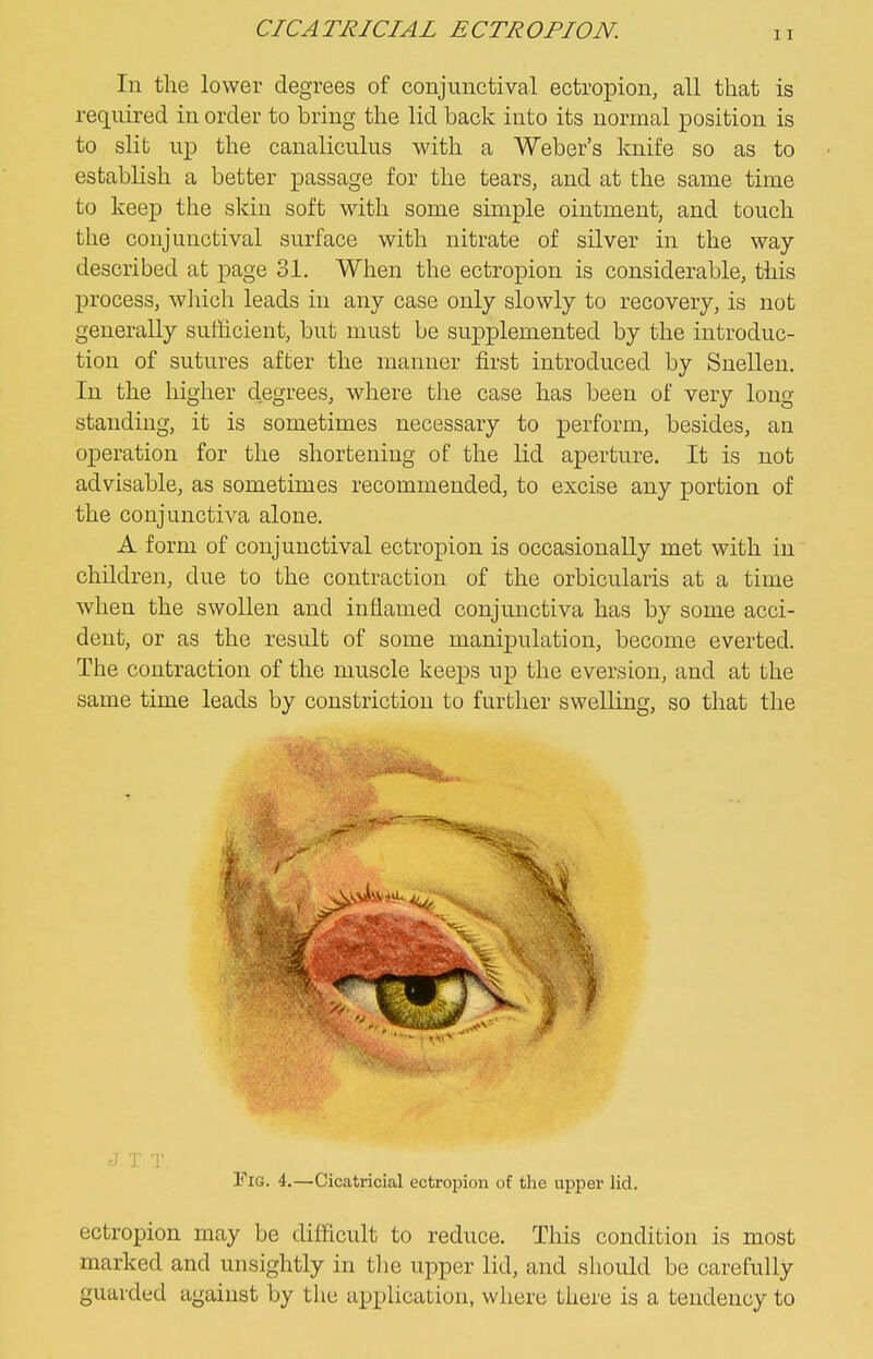 In the lower degrees of conjunctival ectropion, all that is required in order to bring the lid back into its normal position is to slit up the canaliculus with a Weber's knife so as to establish a better passage for the tears, and at the same time to keep the skin soft with some simple ointment, and touch the conjunctival surface with nitrate of silver in the way- described at page 31. When the ectropion is considerable, this process, which leads in any case only slowly to recovery, is not generally sufficient, but must be supplemented by the introduc- tion of sutures after the manner first introduced by Snellen. In the higher degrees, where the case has been of very long standing, it is sometimes necessary to perform, besides, an operation for the shortening of the lid aperture. It is not advisable, as sometimes recommended, to excise any portion of the conjunctiva alone. A form of conjunctival ectropion is occasionally met with in children, due to the contraction of the orbicularis at a time when the swollen and inflamed conjunctiva has by some acci- dent, or as the result of some manipulation, become everted. The contraction of the muscle keeps up the eversion, and at the same time leads by constriction to further swelling, so that the J T, T. Fig. 4.—Cicatricial ectropion of the upper lid. ectropion may be difficult to reduce. This condition is most marked and unsightly in the upper lid, and should be carefully guarded against by the application, where there is a tendency to