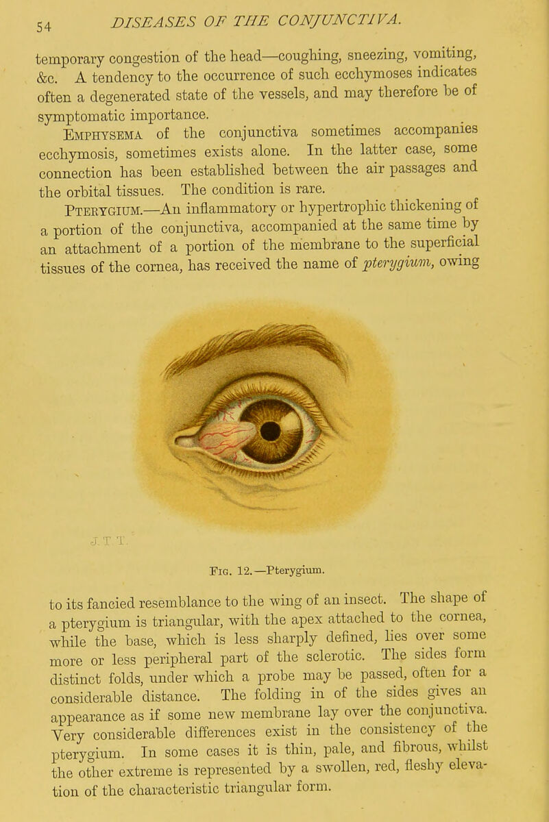 temporary congestion of the head—coughing, sneezing, vomiting, &c. A tendency to the occurrence of such ecchymoses indicates often a degenerated state of the vessels, and may therefore be of symptomatic importance. Emphysema of the conjunctiva sometimes accompanies ecchymosis, sometimes exists alone. In the latter case, some connection has been established between the air passages and the orbital tissues. The condition is rare. Pteetgium.—An inflammatory or hypertrophic thickening of a portion of the conjunctiva, accompanied at the same time by an attachment of a portion of the membrane to the superficial tissues of the cornea, has received the name of pterygium, owing J.T T. Fig. 12.—Pterygitim. to its fancied resemblance to the wing of an insect. The shape of a pterygium is triangular, with the apex attached to the cornea, while the base, which is less sharply defined, hes over some more or less peripheral part of the sclerotic. The sides form distinct folds, under which a probe may be passed, often for a considerable distance. The folding in of the sides gives an appearance as if some new membrane lay over the conjunctiva. Yery considerable differences exist in the consistency of the pterygium. In some cases it is thin, pale, and fibrous, whilst the other extreme is represented by a swollen, red, fleshy eleva- tion of the characteristic triangular form.