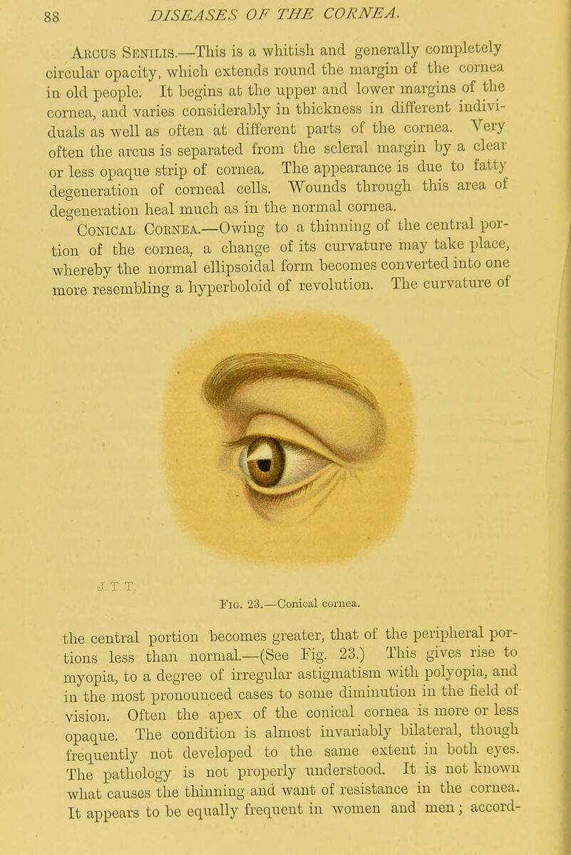 Argus Senilis.—This is a whitish and generally completely circular opacity, which extends round the margin of the cornea in old people. It begins at the upper and lower margins of the cornea, and varies considerably in thickness in different indivi- duals as well as often at diiferent parts of the cornea. Very often the arcus is separated from the scleral margin by a clear or less opaque strip of cornea. The appearance is due to fatty degeneration of corneal cells. Wounds through this area of degeneration heal much as in the normal cornea. Conical Cornea.—Owing to a thinning of the central por- tion of the cornea, a change of its curvature may take place, whereby the normal ellipsoidal form becomes converted into one more resembling a hyperboloid of revolution. The curvature of J. T.T. Fig. 23.—Conical cornea. the central portion becomes greater, that of the peripheral por- tions less than normal.—(See Mg. 23.) This gives rise to myopia, to a degree of irregular astigmatism with polyopia, and in the most pronounced cases to some diminution in the field of vision. Often the apex of the conical cornea is more or less opaque. The condition is almost invariably bilateral, though frequently not developed to the same extent in both eyes. The pathology is not properly understood. It is not known what causes the thinning and want of resistance in the cornea. It appears to be equally frequent in women and men; accord-