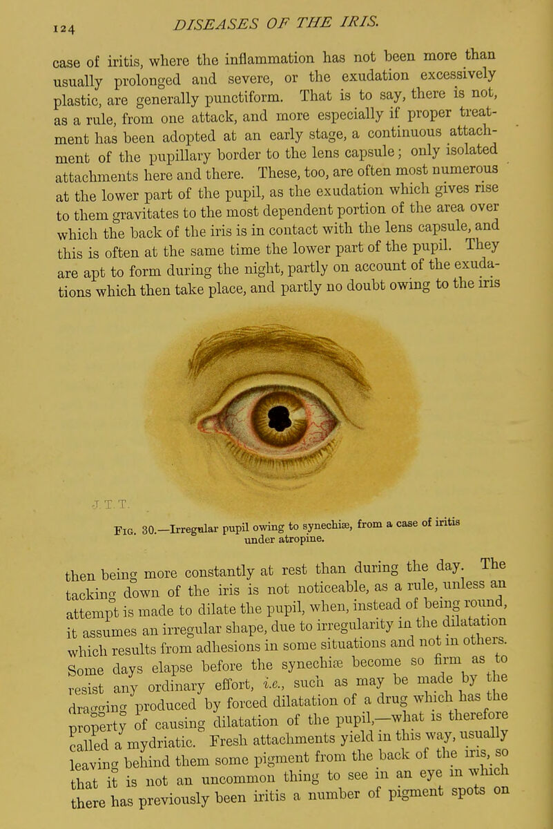 case of iritis, where the inflammation has not been more than usually prolonged and severe, or the exudation excessively plastic, are generally punctiform. That is to say, there is not, as a rule, from one attack, and more especially if proper treat- ment has been adopted at an early stage, a continuous attach- ment of the pupillary border to the lens capsule; only isolated attachments here and there. These, too, are often most numerous at the lower part of the pupil, as the exudation which gives rise to them gravitates to the most dependent portion of the area over which the back of the iris is in contact with the lens capsule, and this is often at the same time the lower part of the pupil. They are apt to form during the night, partly on account of the exuda- tions which then take place, and partly no doubt owing to the iris Fig. 30.-Irregnlar pupil owing to synechia, from a case of iritis under atropine, then beinc more constantly at rest than during the day. The tackincv down of the iris is not noticeable, as a rule, unless an attempt is made to dilate the pupil, when, instead of being iwnd, it assumes an irregular shape, due to irregularity in the dilatation which results from adhesions in some situations and not m othei-s. Some days elapse before the synechias become so firm as to resist any ordinary effort, i.e., such as may be made by he dra-ing produced by forced dilatation of a drug which has the prorertj of causing dilatation of the pupil,-what is therefore Sd a mydriatic. Fresh attachments yield m this way, usually eaving behind them some pigment from the back of the iris,_so that it is not an uncommon thing to see m an eye m winch here has previously been iritis a number of pigment spots on