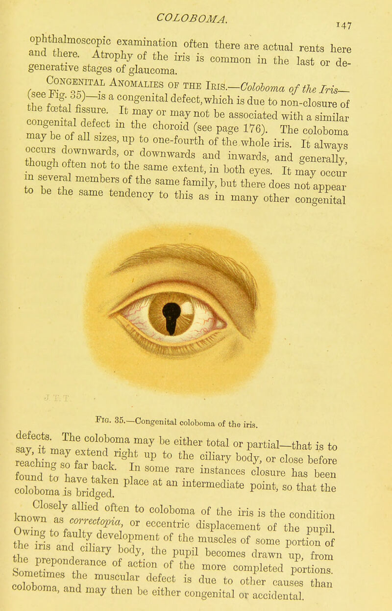 COLOBOMA. ^ ophthalmoscopic examination often there are actual rents here and there. Atrophy of the iris is common in the lasror d generative stages of glaucoma. he flf»,1^~'' ' r^™^' defect,which is due to non-closure of the fcetal fissure. It may or may not be associated with a similar may be of all si.es, up to one-fourth of the whole iris. It always occurs downwards, or downwards and inwards, and geneX though often not to the same extent, in both eye . It may o^ci to be the same tendency to tliis as in many other congenital rio. 35.—Congenital ooloboma of tho iris. defects. The coloboma may be either total or partial-that is to Shlnjfafbl=t '^ '''^ boSy. of close bl o^d to haveI ^1°=™ ha. been corob'oma's bridged '^ - known'S'.f°f ■'dition known as 00-TOiopta, or eccentric displacement of the cunil Owmg to faulty development of the muscles of some portfon'of the ms and crhary body, the pupil becomes drawn up, Tom the preponderance of action of the more completed portionT feomet.mes the muscular defect is due to oufer caus'es ha„ coloboma, and may then be either congenital or accidental