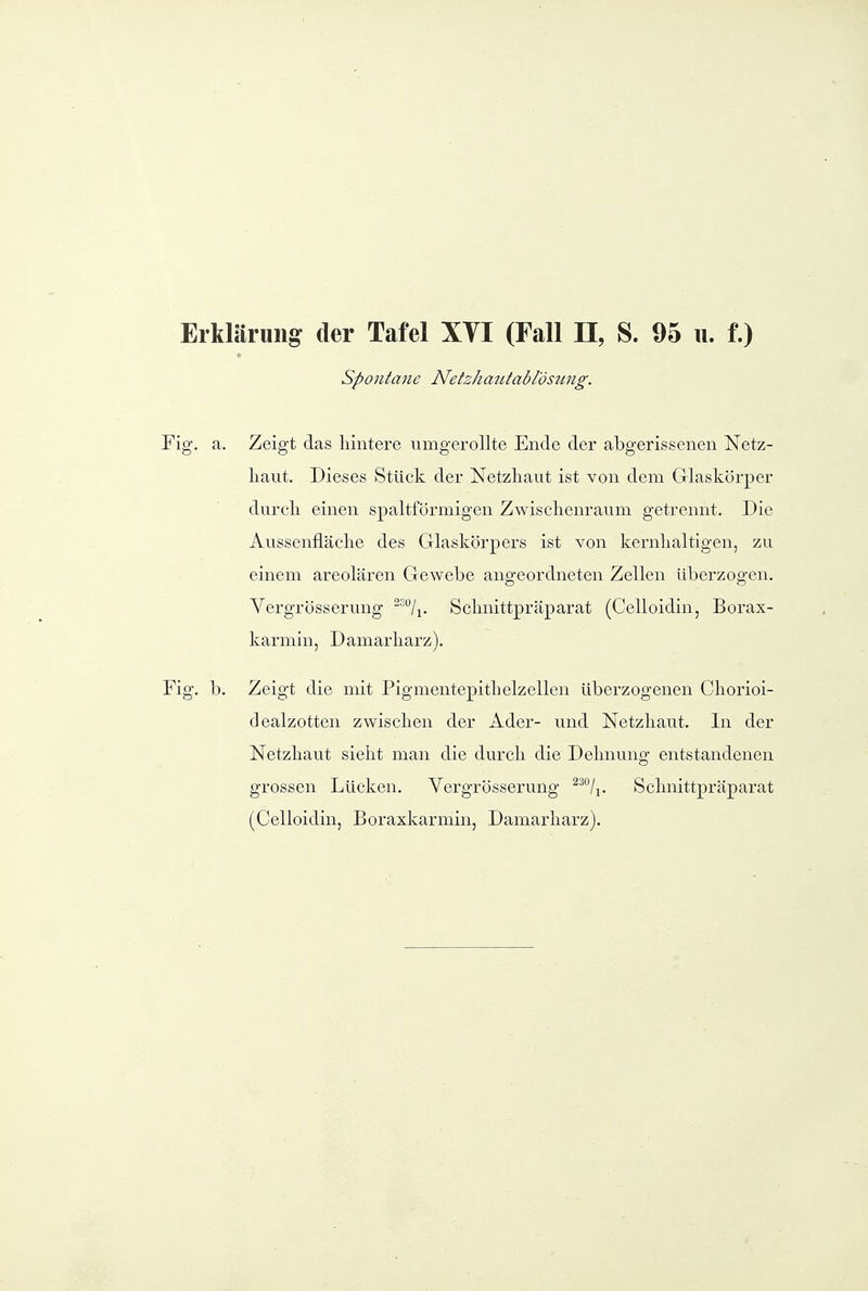 spontane Netzhatitablös2mg. Fig. a. Zeigt das hintere umgerollte Ende der abgerissenen Netz- haut. Dieses Stück der Netzhaut ist von dem Glaskörper durch einen spaltförmigen Zwischenraum getrennt. Die Aussenfläche des Glaskörpers ist von kernhaltigen, zu einem areolären Gewebe angeordneten Zellen überzogen. Yergrösserung -/j. Schnittpräparat (Celloidin, Borax- karmin, Damarharz). Fig. b. Zeigt die mit Pigmentepithelzellen überzogenen Chorioi- dealzotten zwischen der Ader- und Netzhaut. In der Netzhaut sieht man die durch die Dehnung entstandenen grossen Lücken. Yergrösserung ^^/j. Schnittpräparat (Celloidin, Boraxkarmin, Damarharz).