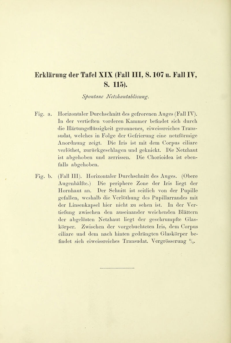 S. 115). Sp07itane Netzhautablösung. Fig. a. Horizontaler Durclisclinitt des gefrorenen Auges (Fall IV). In der vertieften vorderen Kammer befindet sich durcli die Härtungsflüssigkeit geronnenes, eiweissreiclies Trans- sudat, welches in Folge der Gefrierung eine netzförmige Anordnung zeigt. Die Iris ist mit dem Corpus ciliare verlöthet, zuriickgesclilagen und geknickt. Die Netzhaut ist abgehoben und zerrissen. Die Chorioidea ist eben- falls abgehoben. Fig. b. (Fall III). Horizontaler Durchschnitt des Auges. (Obere Augenliälfte.) Die periphere Zone der Iris liegt der Hornhaut an. Der Schnitt ist seitlich Yon der Pupille gefallen, weshalb die Yerlöthung des Pupillarrandes mit der Linsenkapsel hier nicht zu sehen ist. In der Ver- tiefung zwischen den auseinander weichenden Blättern der abgelösten Netzhaut liegt der geschrumpfte Glas- körper. Zwischen der vorgebuchteten Iris, dem Corpus ciliare und dem nach hinten gedrängten Glaskörper be- findet sich eiweissreiches Transudat. Vergrösserung