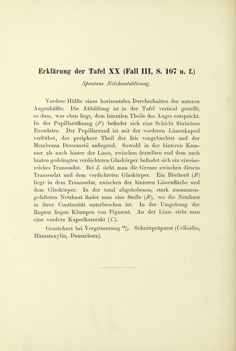 spontane Netzhautablösung. Vordere Ilälfte eines liorizontalen Durdischnittes der unteren Augenliälfte. Die Abbildung ist in der Tafel vertical gestellt, so dass, was oben liegt, dem lateralen Tlieile des Auges entspricht. In der PupillarÖffnung {F) befindet sich eine Scliiclit fibrinösen Exsudates. Der Pupillarrand ist mit der vorderen Linsenkapsel verlöthet, der periphere Theil der Iris vorgebuchtet und der Membrana Descemetii anliegend. Sowohl in der hinteren Kam- mer als auch hinter der Linse, zwischen derselben und dem nach hinten gedrängten verdichteten Glaskörper befindet sich ein eiweiss- reiches Transsudat. Bei L sieht man die Grenze zwischen diesem ^Vanssudat und dem verdichteten Glaskörper. Ein Blutherd (B) liegt in dem Transsudat, zwischen der hinteren Linsenfläche und dem Glaskörper. In der total abgehobenen, stark zusammen- gefalteten Netzhaut findet man eine Stelle (i?), wo die Netzhaut in ihrer Continuität unterbrochen ist. In der Umgebung der Euptur liegen Klumpen von Pigment. An der Linse sieht man eine vordere Kapselkatarakt (C). Gezeichnet bei Vergrösserung ^7i- Schnittpräparat (Celloidin, Hämatoxylin, Damarharz).