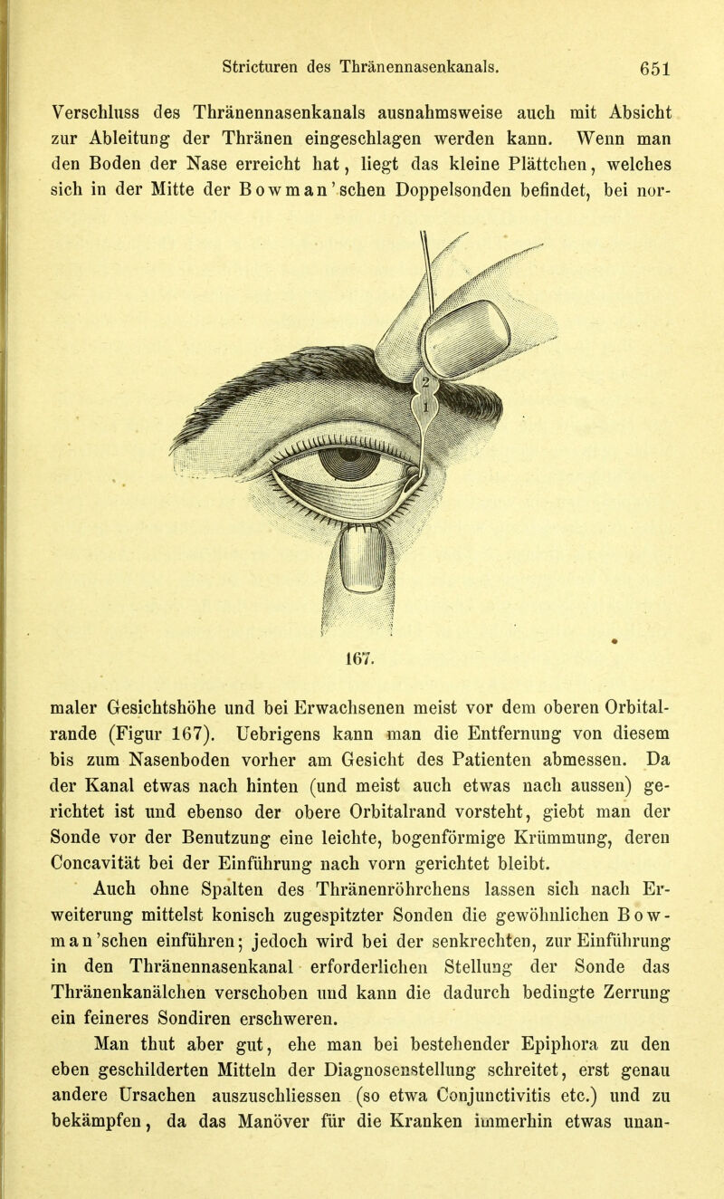 Verschluss des Thränennasenkanals ausnahmsweise auch mit Absicht zur Ableitung der Thränen eingeschlagen werden kann. Wenn man den Boden der Nase erreicht hat, liegt das kleine Plättchen, welches sich in der Mitte der Bowman'sehen Doppelsonden befindet, bei nor- 167. maier Gesichtshöhe und bei Erwachsenen meist vor dem oberen Orbital- rande (Figur 167). Uebrigens kann man die Entfernung von diesem bis zum Nasenboden vorher am Gesicht des Patienten abmessen. Da der Kanal etwas nach hinten (und meist auch etwas nach aussen) ge- richtet ist und ebenso der obere Orbitalrand vorsteht, giebt man der Sonde vor der Benutzung eine leichte, bogenförmige Krümmung, deren Concavität bei der Einführung nach vorn gerichtet bleibt. Auch ohne Spalten des Thränenröhrchens lassen sich nach Er- weiterung mittelst konisch zugespitzter Sonden die gewöhnlichen Bow- man'sehen einführen; jedoch wird bei der senkrechten, zur Einführung in den Thränennasenkanal erforderlichen Stellung der Sonde das Thränenkanälchen verschoben und kann die dadurch bedingte Zerrung ein feineres Sondiren erschweren. Man thut aber gut, ehe man bei bestehender Epiphora zu den eben geschilderten Mitteln der Diagnosenstellung schreitet, erst genau andere Ursachen auszuschliessen (so etwa Conjunctivitis etc.) und zu bekämpfen, da das Manöver für die Kranken immerhin etwas unan-