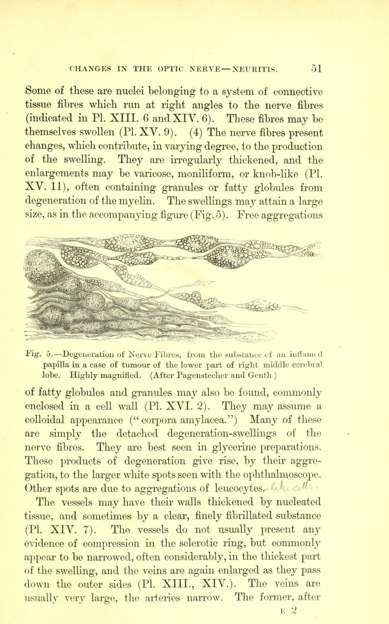 Some of these are nuclei belonging to a system of connective tissue fibres which run at right angles to the nerve fibres (indicated in PL XIII. 6 and XIV. 6). These fibres may be themselves swollen (PL XV. 9). (4) The nerve fibres present changes, which contribute, in varying degree, to the production of the swelling. They are irregularly thickened, and the enlargements may be varicose, moniliform, or knob-like (PL XV. 11), often containing granules or fatty globules from degeneration of the myelin. The swellings may attain a large size, as in the accompanying figure (Fig. 5). Free aggregations Fig-. 5.—Degeneration of Nerve Fibres, from the substance of an inflamed papilla in a case of tumour of the lower part of right middle cerebral lobe. Highly magnified. (After Pagenstecher and Genth) of fatty globules and granules may also be found, commonly enclosed in a cell wall (PL XVI. 2). They may assume a colloidal appearance ( corpora amylacea.) Many of these are simply the detached degeneration-swellings of the nerve fibres. They are best seen in glycerine preparations. These products of degeneration give rise, by their aggre- gation, to the larger white spots seen with the ophthalmoscope. Other spots are due to aggregations of leucocytes.- <khj. The vessels may have their walls thickened by nucleated tissue, and sometimes by a clear, finely fibrillated substance (PL XIV. 7). The vessels do not usually present any evidence of compression in the sclerotic ring, but commonly appear to be narrowed, often considerably, in the thickest part of the swelling, and the veins are again enlarged as they pass down the outer sides (PL XIII., XIV.). The veins are usually very large, the arteries narrow. The former, after e 2