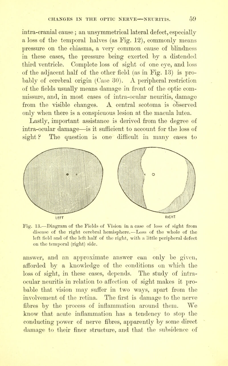 intra-cranial cause ; an unsymmetrical lateral defect, especially a loss of the temporal halves (as Fig. 12), commonly means pressure on the chiasma, a very common cause of blindness in these cases, the pressure being exerted by a distended third ventricle. Complete loss of sight of one eye, and loss of the adjacent half of the other field (as in Fig. 13) is pro- bably of cerebral origin (Case 30). A peripheral restriction of the fields usually means damage in front of the optic com- missure, and, in most cases of intra-ocular neuritis, damage from the visible changes. A central scotoma is observed only when there is a conspicuous lesion at the macula lutea. Lastly, important assistance is derived from the degree of intra-ocular damage—is it sufficient to account for the loss of sight ? The question is one difficult in many cases to LEFT R«GHT Fig. 13.—Diagram of the Fields of Vision in a case of loss of sight from disease of the right cerebral hemisphere.—Loss of the whole of the left field and of the left half of the right, with a little peripheral defect on the temporal (right) side. answer, and an approximate answer can only be given, afforded by a knowledge of the conditions on which the loss of sight, in these cases, depends. The study of intra- ocular neuritis in relation to affection of sight makes it pro- bable that vision may suffer in two ways, apart from the involvement of the retina. The first is damage to the nerve fibres by the process of inflammation around them. We know that acute inflammation has a tendency to stop the conducting power of nerve fibres, apparently by some direct damage to their finer structure, and that the subsidence of