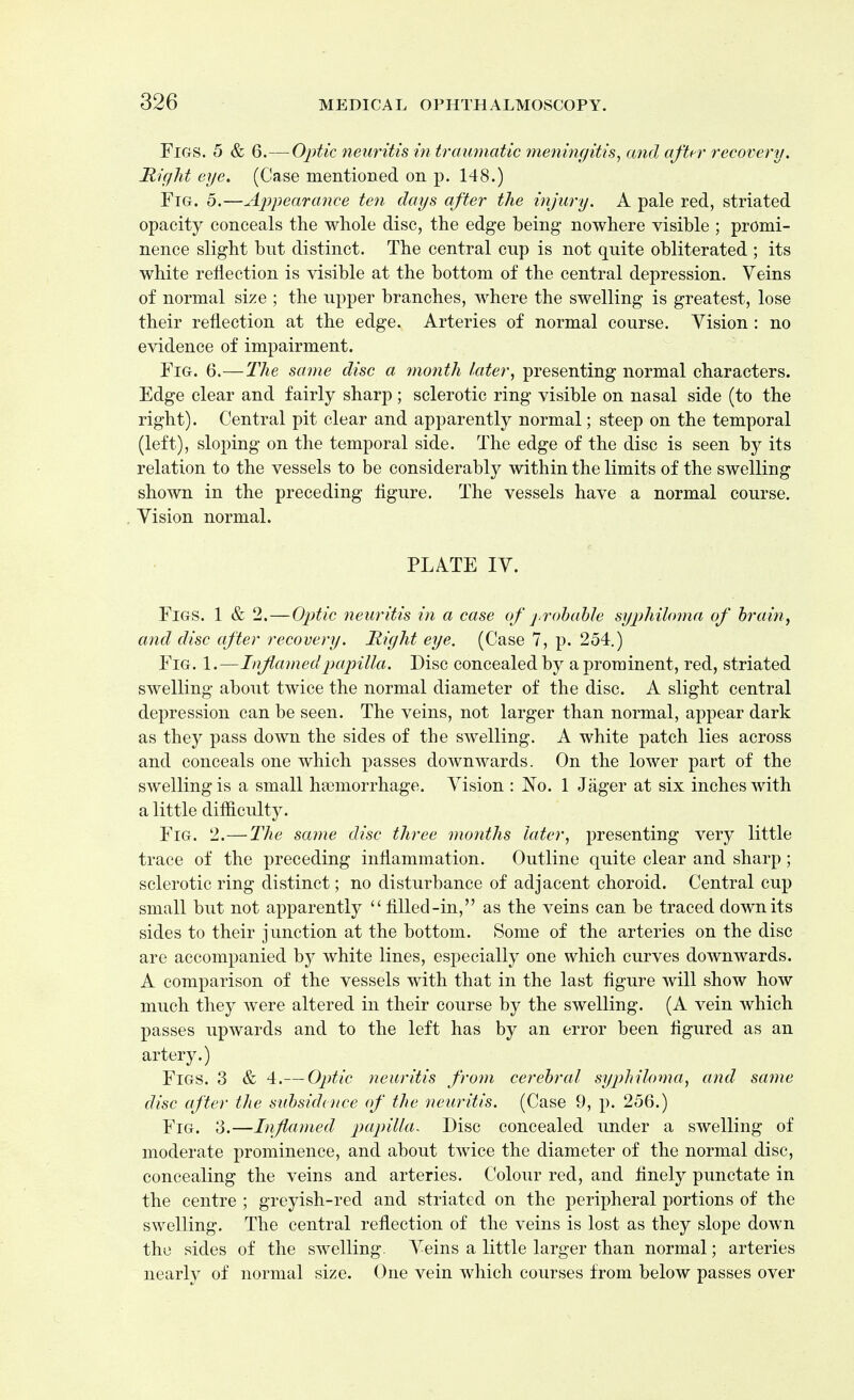 Figs. 5 & 6.—Optic neuritis in traumatic meningitis, and after recovery. Right eye. (Case mentioned on p. 148.) Fig. 5.—Appearance ten days after the injury. A pale red, striated opacity conceals the whole disc, the edge being nowhere visible ; promi- nence slight but distinct. The central cup is not quite obliterated ; its white reflection is visible at the bottom of the central depression. Veins of normal size ; the upper branches, where the swelling is greatest, lose their reflection at the edge. Arteries of normal course. Vision : no evidence of impairment. Fig. 6.—The same disc a month later, presenting normal characters. Edge clear and fairly sharp; sclerotic ring visible on nasal side (to the right). Central pit clear and apparently normal; steep on the temporal (left), sloping on the temporal side. The edge of the disc is seen by its relation to the vessels to be considerably within the limits of the swelling shown in the preceding figure. The vessels have a normal course. Vision normal. PLATE IV. Figs. 1 & 2.—Optic neuritis in a case of probable syphiloma of brain, and disc after recovery. Right eye. (Case 7, p. 254.) Fig. 1.—Inflamed papilla. Disc concealed by a prominent, red, striated swelling about twice the normal diameter of the disc. A slight central depression can be seen. The veins, not larger than normal, appear dark as they pass down the sides of the swelling. A white patch lies across and conceals one which passes downwards. On the lower part of the swelling is a small haemorrhage. Vision : No. 1 Jager at six inches with a little difficulty. Fig. 2.—The same disc three months later, presenting very little trace of the preceding inflammation. Outline quite clear and sharp; sclerotic ring distinct; no disturbance of adjacent choroid. Central cup small but not apparently  filled-in, as the veins can be traced down its sides to their junction at the bottom. Some of the arteries on the disc are accompanied by white lines, especially one which curves downwards. A comparison of the vessels with that in the last figure will show how much they were altered in their course by the swelling. (A vein which passes upwards and to the left has by an error been figured as an artery.) Figs. 3 & 4.— Optic neuritis from cerebral syphiloma, and same disc after the subsidence of the neuritis. (Case 9, p. 256.) Fig. 3.—Inflamed papilla. Disc concealed under a swelling of moderate prominence, and about twice the diameter of the normal disc, concealing the veins and arteries. Colour red, and finely punctate in the centre ; greyish-red and striated on the peripheral portions of the swelling. The central reflection of the veins is lost as they slope down the sides of the swelling. Veins a little larger than normal; arteries nearly of normal size. One vein which courses from below passes over