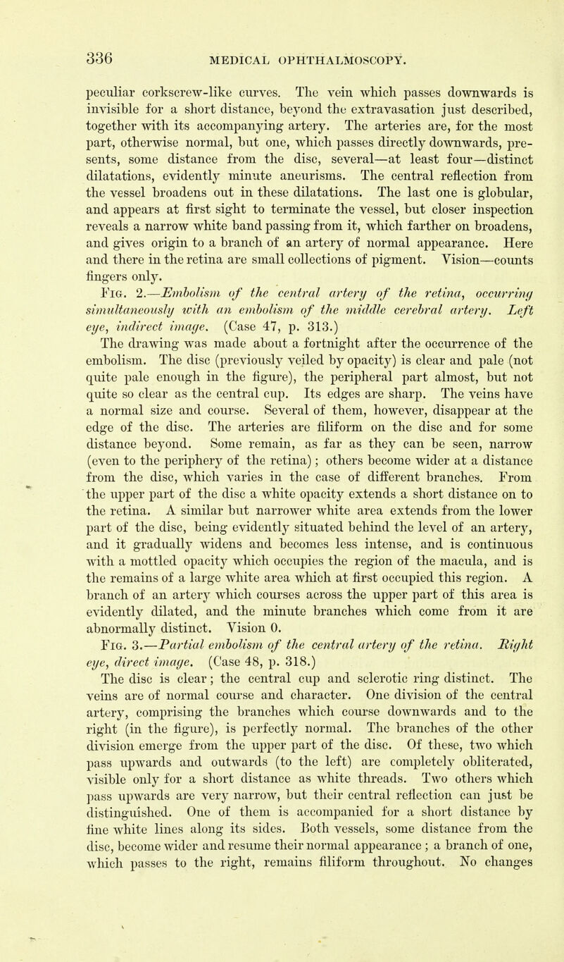 peculiar corkscrew-like curves. The vein which passes downwards is invisible for a short distance, beyond the extravasation just described, together with its accompanying artery. The arteries are, for the most part, otherwise normal, but one, which passes directly downwards, pre- sents, some distance from the disc, several—at least four—distinct dilatations, evidently minute aneurisms. The central reflection from the vessel broadens out in these dilatations. The last one is globular, and appears at first sight to terminate the vessel, but closer inspection reveals a narrow white band passing from it, which farther on broadens, and gives origin to a branch of an artery of normal appearance. Here and there in the retina are small collections of pigment. Vision—counts fingers only. Fig. 2.—Embolism of the central artery of the retina, occurring simultaneously with an embolism of the middle cerebral artery. Left eye, indirect image. (Case 47, p. 313.) The drawing was made about a fortnight after the occurrence of the embolism. The disc (previously veiled by opacity) is clear and pale (not quite pale enough in the figure), the peripheral part almost, but not quite so clear as the central cup. Its edges are sharp. The veins have a normal size and course. Several of them, however, disappear at the edge of the disc. The arteries are filiform on the disc and for some distance beyond. Some remain, as far as they can be seen, narrow (even to the periphery of the retina); others become wider at a distance from the disc, which varies in the case of different branches. From the upper part of the disc a white opacity extends a short distance on to the retina. A similar but narrower white area extends from the lower part of the disc, being evidently situated behind the level of an artery, and it gradually widens and becomes less intense, and is continuous with a mottled opacity which occupies the region of the macula, and is the remains of a large white area which at first occupied this region. A branch of an artery which courses across the upper part of this area is evidently dilated, and the minute branches which come from it are abnormally distinct. Vision 0. Fig. 3.—Partial embolism of the central artery of the retina. Right eye, direct image. (Case 48, p. 318.) The disc is clear; the central cup and sclerotic ring distinct. The veins are of normal course and character. One division of the central artery, comprising the branches which course downwards and to the right (in the figure), is perfectly normal. The branches of the other division emerge from the upper part of the disc. Of these, two which pass upwards and outwards (to the left) are completely obliterated, visible only for a short distance as white threads. Two others which pass upwards are very narrow, but their central reflection can just be distinguished. One of them is accompanied for a short distance by fine white lines along its sides. Both vessels, some distance from the disc, become wider and resume their normal appearance ; a branch of one, which passes to the right, remains filiform throughout. No changes