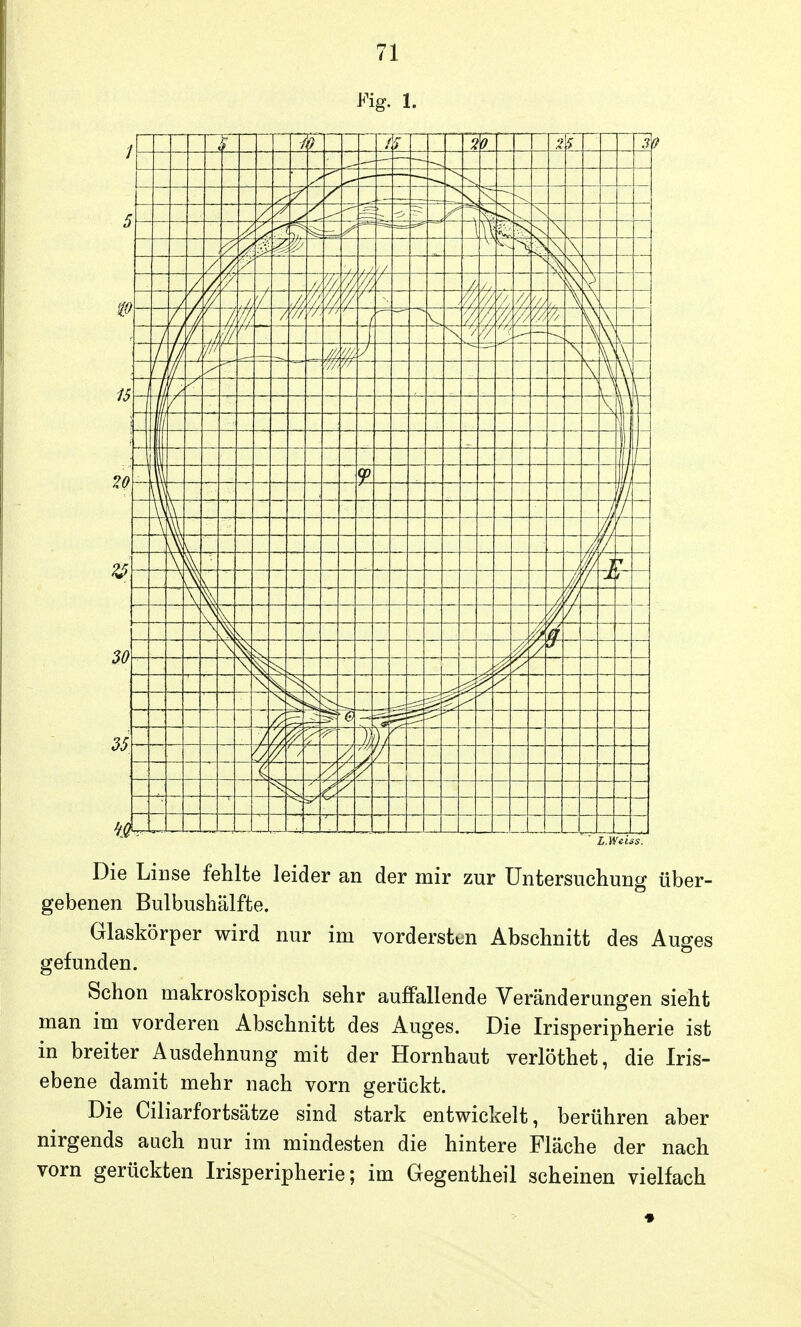 Fig. 1. l.Wciss. Die Linse fehlte leider an der mir zur Untersuchung über- gebenen Bulbushälfte. Glaskörper wird nur im vordersten Abschnitt des Auges gefunden. Schon makroskopisch sehr auffallende Veränderungen sieht man im vorderen Abschnitt des Auges. Die Irisperipherie ist in breiter Ausdehnung mit der Hornhaut verlöthet, die Iris- ebene damit mehr nach vorn gerückt. Die Ciliarfortsätze sind stark entwickelt, berühren aber nirgends auch nur im mindesten die hintere Fläche der nach vorn gerückten Irisperipherie; im Gegentheil scheinen vielfach