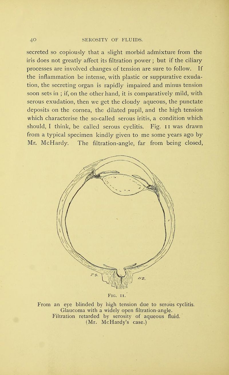 secreted so copiously that a slight morbid admixture from the iris does not greatly affect its filtration power ; but if the ciliary processes are involved changes of tension are sure to follow. If the inflammation be intense, with plastic or suppurative exuda- tion, the secreting organ is rapidly impaired and minus tension soon sets in ; if, on the other hand, it is comparatively mild, with serous exudation, then we get the cloudy aqueous, the punctate deposits on the cornea, the dilated pupil, and the high tension which characterise the so-called serous iritis, a condition which should, I think, be called serous cyclitis. Fig. 11 was drawn from a typical specimen kindly given to me some years ago by Mr, McHardy. The filtration-angle, far from being closed, Fig. ii. From an eye blinded by high tension due to serous cyclitis. Glaucoma with a widely open filtration-angle. Filtration retarded by serosity of aqueous fluid. (Mr. McHardy's case.)