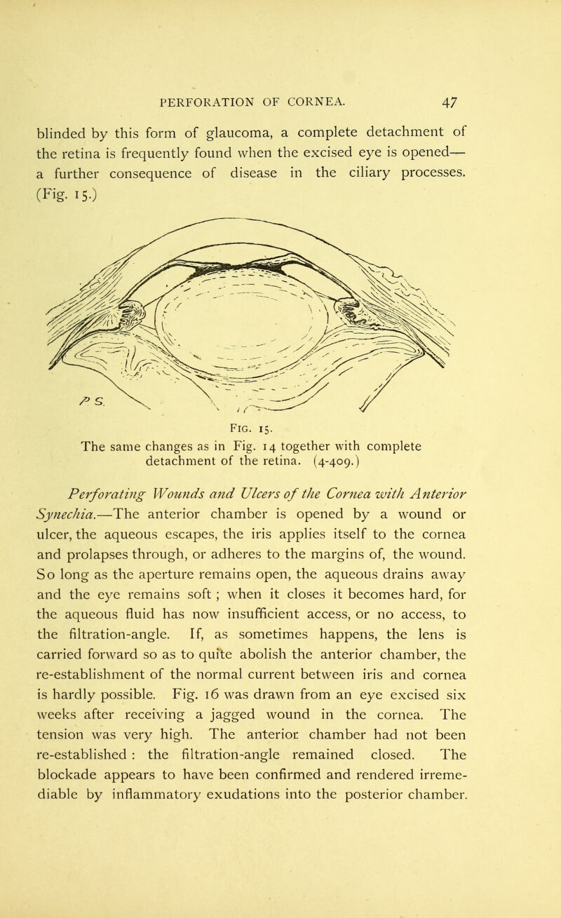 blinded by this form of glaucoma, a complete detachment of the retina is frequently found when the excised eye is opened— a further consequence of disease in the ciliary processes. (Fig. 150 Fig. 15. The same changes as in Fig. 14 together with complete detachment of the retina. (4-409.) Perforating Wounds and Ulcers of the Cornea with Anterior Synechia.—The anterior chamber is opened by a wound or ulcer, the aqueous escapes, the iris applies itself to the cornea and prolapses through, or adheres to the margins of, the wound. So long as the aperture remains open, the aqueous drains away and the eye remains soft ; when it closes it becomes hard, for the aqueous fluid has now insufficient access, or no access, to the filtration-angle. If, as sometimes happens, the lens is carried forward so as to quite abolish the anterior chamber, the re-establishment of the normal current between iris and cornea is hardly possible. Fig. 16 was drawn from an eye excised six weeks after receiving a jagged wound in the cornea. The tension was very high. The anterior chamber had not been re-established : the filtration-angle remained closed. The blockade appears to have been confirmed and rendered irreme- diable by inflammatory exudations into the posterior chamber.