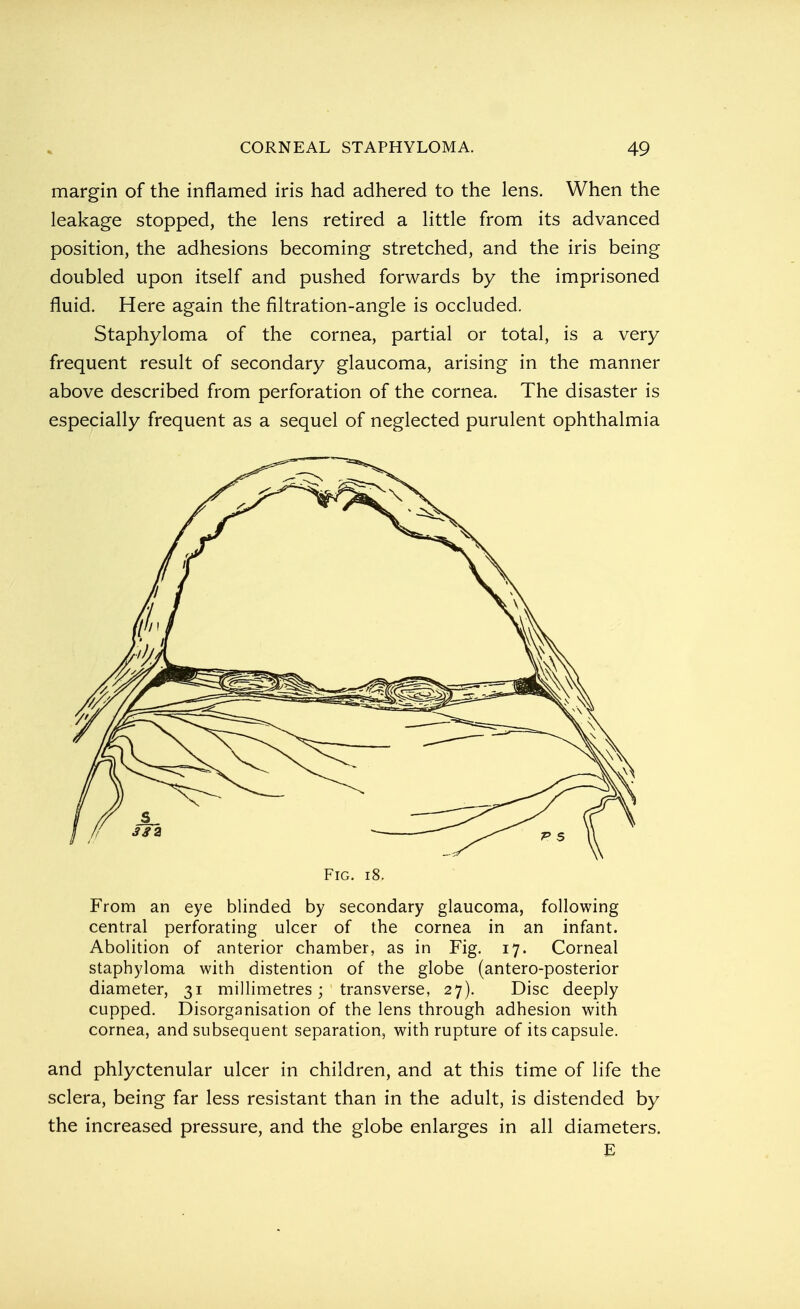 margin of the inflamed iris had adhered to the lens. When the leakage stopped, the lens retired a little from its advanced position, the adhesions becoming stretched, and the iris being doubled upon itself and pushed forwards by the imprisoned fluid. Here again the filtration-angle is occluded. Staphyloma of the cornea, partial or total, is a very frequent result of secondary glaucoma, arising in the manner above described from perforation of the cornea. The disaster is especially frequent as a sequel of neglected purulent ophthalmia Fig. 18. From an eye blinded by secondary glaucoma, following central perforating ulcer of the cornea in an infant. Abolition of anterior chamber, as in Fig. 17. Corneal staphyloma with distention of the globe (antero-posterior diameter, 31 millimetres; transverse, 27). Disc deeply cupped. Disorganisation of the lens through adhesion with cornea, and subsequent separation, with rupture of its capsule. and phlyctenular ulcer in children, and at this time of life the sclera, being far less resistant than in the adult, is distended by the increased pressure, and the globe enlarges in all diameters. E