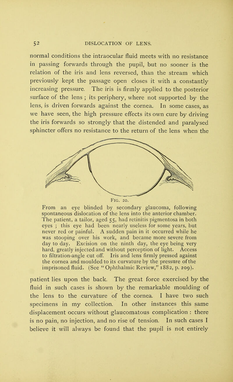 normal conditions the intraocular fluid meets with no resistance in passing forwards through the pupil, but no sooner is the relation of the iris and lens reversed, than the stream which previously kept the passage open closes it with a constantly increasing pressure. The iris is firmly applied to the posterior surface of the lens ; its periphery, where not supported by the lens, is driven forwards against the cornea. In some cases, as we have seen, the high pressure effects its own cure by driving the iris forwards so strongly that the distended and paralysed sphincter offers no resistance to the return of the lens when the Fig. 20. From an eye blinded by secondary glaucoma, following spontaneous dislocation of the lens into the anterior chamber. The patient, a tailor, aged 55, had retinitis pigmentosa in both eyes ; this eye had been nearly useless for some years, but never red or painful. A sudden pain in it occurred while he was stooping over his work, and became more severe from day to day. Excision on the ninth day, the eye being very hard, greatly injected and without perception of light. Access to filtration-angle cut off. Iris and lens firmly pressed against the cornea and moulded to its curvature by the pressure of the imprisoned fluid. (See  Ophthalmic Review, 1882, p. 209). patient lies upon the back. The great force exercised by the fluid in such cases is shown by the remarkable moulding of the lens to the curvature of the cornea. I have two such specimens in my collection. In other instances this same displacement occurs without glaucomatous complication : there is no pain, no injection, and no rise of tension. In such cases I believe it will always be found that the pupil is not entirely