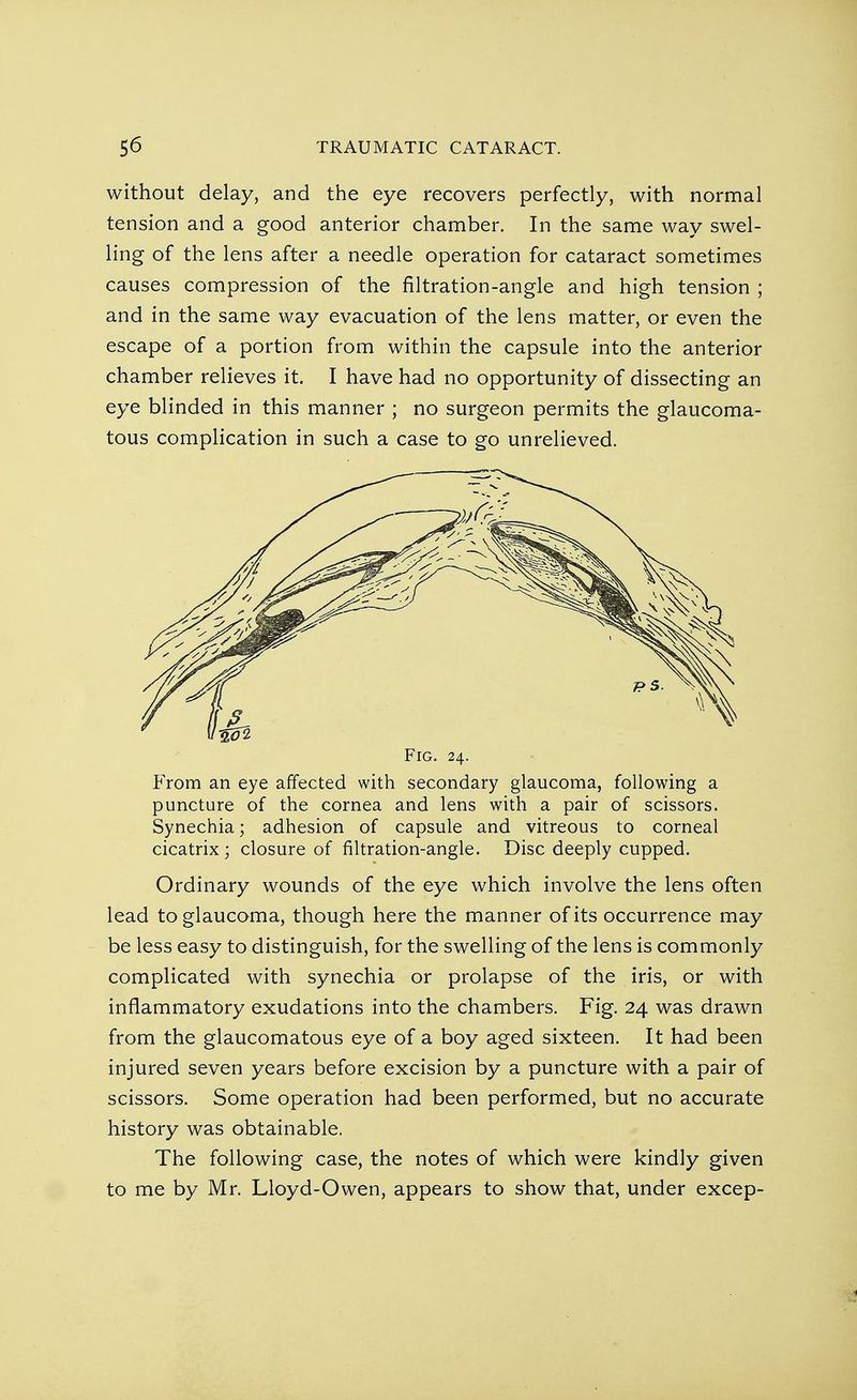 without delay, and the eye recovers perfectly, with normal tension and a good anterior chamber. In the same way swel- ling of the lens after a needle operation for cataract sometimes causes compression of the filtration-angle and high tension ; and in the same way evacuation of the lens matter, or even the escape of a portion from within the capsule into the anterior chamber relieves it. I have had no opportunity of dissecting an eye blinded in this manner ; no surgeon permits the glaucoma- tous complication in such a case to go unrelieved. Fig. 24. From an eye affected with secondary glaucoma, following a puncture of the cornea and lens with a pair of scissors. Synechia; adhesion of capsule and vitreous to corneal cicatrix; closure of filtration-angle. Disc deeply cupped. Ordinary wounds of the eye which involve the lens often lead to glaucoma, though here the manner of its occurrence may be less easy to distinguish, for the swelling of the lens is commonly complicated with synechia or prolapse of the iris, or with inflammatory exudations into the chambers. Fig. 24 was drawn from the glaucomatous eye of a boy aged sixteen. It had been injured seven years before excision by a puncture with a pair of scissors. Some operation had been performed, but no accurate history was obtainable. The following case, the notes of which were kindly given to me by Mr. Lloyd-Owen, appears to show that, under excep- 1