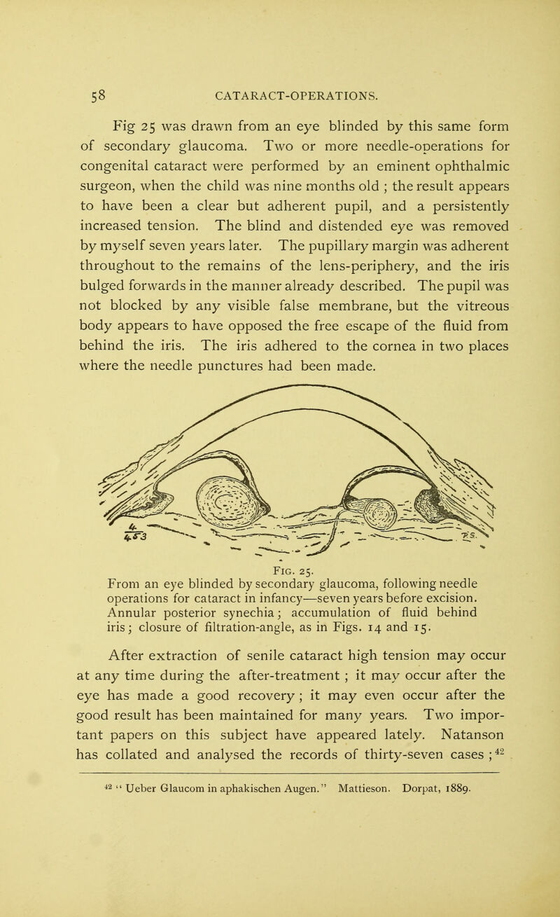 Fig 25 was drawn from an eye blinded by this same form of secondary glaucoma. Two or more needle-operations for congenital cataract were performed by an eminent ophthalmic surgeon, when the child was nine months old ; the result appears to have been a clear but adherent pupil, and a persistently increased tension. The blind and distended eye was removed by myself seven years later. The pupillary margin was adherent throughout to the remains of the lens-periphery, and the iris bulged forwards in the manner already described. The pupil was not blocked by any visible false membrane, but the vitreous body appears to have opposed the free escape of the fluid from behind the iris. The iris adhered to the cornea in two places where the needle punctures had been made. Fig. 25. From an eye blinded by secondary glaucoma, following needle operations for cataract in infancy—seven years before excision. Annular posterior synechia; accumulation of fluid behind iris; closure of filtration-angle, as in Figs. 14 and 15. After extraction of senile cataract high tension may occur at any time during the after-treatment ; it may occur after the eye has made a good recovery ; it may even occur after the good result has been maintained for many years. Two impor- tant papers on this subject have appeared lately. Natanson has collated and analysed the records of thirty-seven cases ;42 42  Ueber Glaucom in aphakischen Augen. Mattieson. Dorpat, 1889.