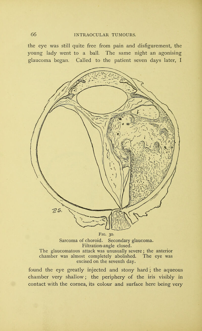 the eye was still quite free from pain and disfigurement, the young lady went to a ball. The same night an agonising glaucoma began. Called to the patient seven days later, I Fig. 30. Sarcoma of choroid. Secondary glaucoma. Filtration-angle closed. The glaucomatous attack was unusually severe; the anterior chamber was almost completely abolished. The eye was excised on the seventh day. found the eye greatly injected and stony hard ; the aqueous chamber very shallow; the periphery of the iris visibly in contact with the cornea, its colour and surface here being very