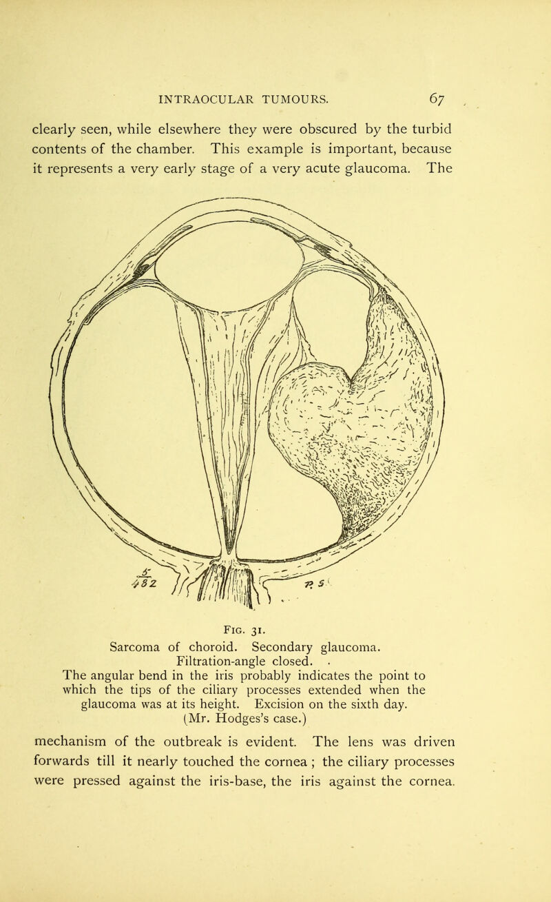 clearly seen, while elsewhere they were obscured by the turbid contents of the chamber. This example is important, because it represents a very early stage of a very acute glaucoma. The Fig. 31. Sarcoma of choroid. Secondary glaucoma. Filtration-angle closed. . The angular bend in the iris probably indicates the point to which the tips of the ciliary processes extended when the glaucoma was at its height. Excision on the sixth day. (Mr. Hodges's case.) mechanism of the outbreak is evident. The lens was driven forwards till it nearly touched the cornea ; the ciliary processes were pressed against the iris-base, the iris against the cornea.