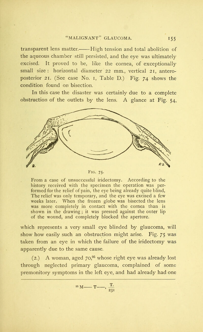 MALIGNANT glaucoma. transparent lens matter. High tension and total abolition of the aqueous chamber still persisted, and the eye was ultimately excised. It proved to be, like the cornea, of exceptionally small size : horizontal diameter 22 mm., vertical 21, antero- posterior 21. (See case No. 1, Table D.) Fig. 74 shows the condition found on bisection. In this case the disaster was certainly due to a complete obstruction of the outlets by the lens. A glance at Fig. 54, From a case of unsuccessful iridectomy. According to the history received with the specimen the operation was per- formed for the relief of pain, the eye being already quite blind, The relief was only temporary, and the eye was excised a few weeks later. When the frozen globe was bisected the lens was more completely in contact with the cornea than is shown in the drawing; it was pressed against the outer lip of the wound, and completely blocked the aperture. which represents a very small eye blinded by glaucoma, will show how easily such an obstruction might arise. Fig. 75 was taken from an eye in which the failure of the iridectomy was apparently due to the same cause. (2.) A woman, aged 70,95 whose right eye was already lost through neglected primary glaucoma, complained of some premonitory symptoms in the left eye, and had already had one Fig. 75. 95 m