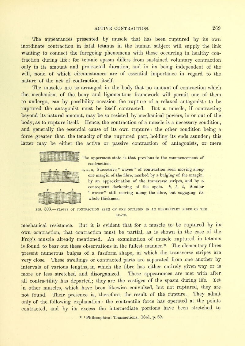 The appearances presented by muscle that has been ruptured by its own inordinate contraction in fatal tetanus in the human subject will supply the link wanting to connect the foregoing phenomena with those occurring in healthy con- traction during life: for tetanic spasm differs from sustained voluntary contraction only in its amount and protracted duration, and in its being independent of the will, none of which circumstances are of essential importance in regard to the nature of the act of contraction itself. The muscles are so arranged in the body that no amount of contraction which the mechanism of the bony and ligamentous framework will permit one of them to undergo, can by possibility occasion the rupture of a relaxed antagonist: to be ruptured the antagonist must be itself contracted. But a muscle, if contracting beyond its natural amount, may be so resisted by mechanical powers, in or out of the body, as to rupture itself. Hence, the contraction of a muscle is a necessary condition, and generally the essential cause of its own rupture: the other condition being a force greater than the tenacity of the ruptured part, holding its ends asunder; this latter may be either the active or passive contraction of antagonists, or mere The uppermost state is that previous to the commencement of contraction. a, a, a, Successive waves of contraction seen moving along one margin of the fibre, marked by a bulging of the margin, by an approximation of the transverse stripes, and by a consequent darkening of the spots. b, b, b, Similar  waves  still moving along the fibre, but engaging its whole thickness. FIG. 303.—STAGES OF CONTRACTION SEEN ON ONE OCCASION IN AN ELEMENTARY FIBRE OF THE SKATE. mechanical resistance. But it is evident that for a muscle to be ruptured by its own contraction, that contraction must be partial, as is shown in the case of the Frog's muscle already mentioned. An examination of muscle ruptured in tetanus is found to bear out these observations in the fullest manner.* The elementary fibres present numerous bulges of a fusiform shape, in which the transverse stripes are very close. These swellings or contracted parts are separated from one another by intervals of various lengths, in which the fibre has either entirely given way or is more or less stretched and disorganized. These appearances are met with after all contractility has departed; they are the vestiges of the spasm during life. Yet in other muscles, which have been likewise convulsed, but not ruptured, they are not found. Their presence is, therefore, the result of the rupture. They admit only of the following explanation: the contractile force has operated at the points contracted, and by its excess the intermediate portions have been stretched to