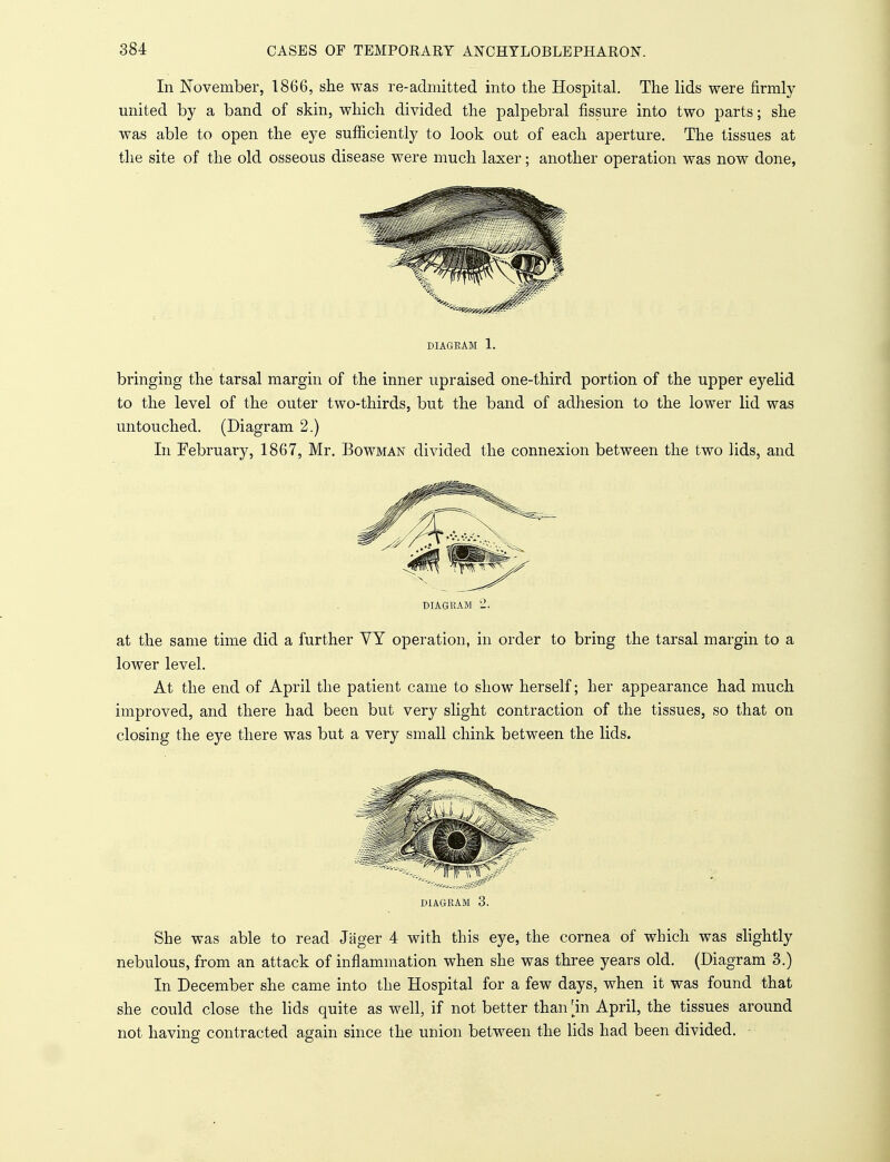 In November, 1866, she was re-admitted into the Hospital. The lids were firmly united by a band of skin, which divided the palpebral fissure into two parts; she was able to open the eye sufficiently to look out of each aperture. The tissues at the site of the old osseous disease were much laxer; another operation was now done, DIAGRAM 1. bringing the tarsal margin of the inner upraised one-third portion of the upper eyelid to the level of the outer two-thirds, but the band of adhesion to the lower lid was untouched. (Diagram 2.) In February, 1867, Mr. Bowman divided the connexion between the two lids, and DIAGRAM at the same time did a further VY operation, in order to bring the tarsal margin to a lower level. At the end of April the patient came to show herself; her appearance had much improved, and there had been but very slight contraction of the tissues, so that on closing the eye there was but a very small chink between the lids. She was able to read Jager 4 with this eye, the cornea of which was slightly nebulous, from an attack of inflammation when she was three years old. (Diagram 3.) In December she came into the Hospital for a few days, when it was found that she could close the lids quite as well, if not better than 'in April, the tissues around not having contracted again since the union between the lids had been divided.