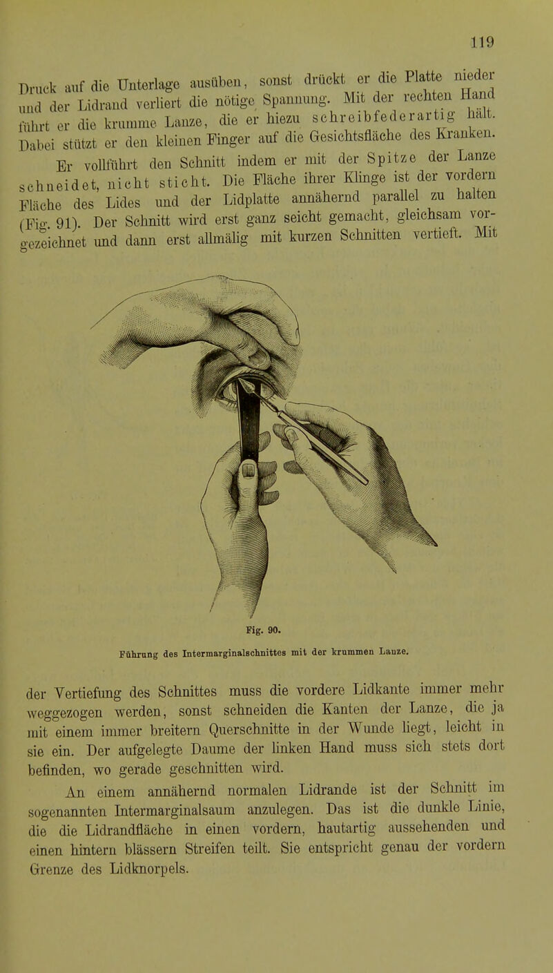 Pnick mif die Unterlage ausüben, sonst drückt er die Platte niedei und der Lidraud verliert die nötige Spannung. Mit der rechten Hand Ifdirt er die krumme Lanze, die er hiezu sohreibfederartig halt. Dabei stutzt er den kleinen Finger auf die Gesichtsflache des Kranken. Er vollflihrt den Schnitt indem er mit der Spitze der Lanze schneidet, nicht sticht. Die Fläche ihrer Klinge ist der vordern Flache des Lides und der Lidplatte annähernd parallel zu halten (Fie. 91). Der Schnitt wird erst ganz seicht gemacht, gleichsam vor- gezTichnet und dann erst allmälig mit kurzen Schnitten vertieft. Mit Fig. 90. Führung des Intermarginalschnittes mit der krummen Lanze. der Vertiefung des Schnittes muss die vordere Lidkante immer mehr weggezogen werden, sonst schneiden die Kanten der Lanze, die ja mit einem immer breitem Querschnitte in der Wunde liegt, leicht in sie ein. Der aufgelegte Daume der linken Hand muss sich stets dort befinden, wo gerade geschnitten wird. An einem annähernd normalen Lidrande ist der Schnitt im sogenannten Intermarginalsaum anzulegen. Das ist die dunkle Linie, die die Lidrandfiäche in einen vordern, hautartig aussehenden und einen hintern blassem Streifen teilt. Sie entspricht genau der vordem Grenze des Lidknorpels.