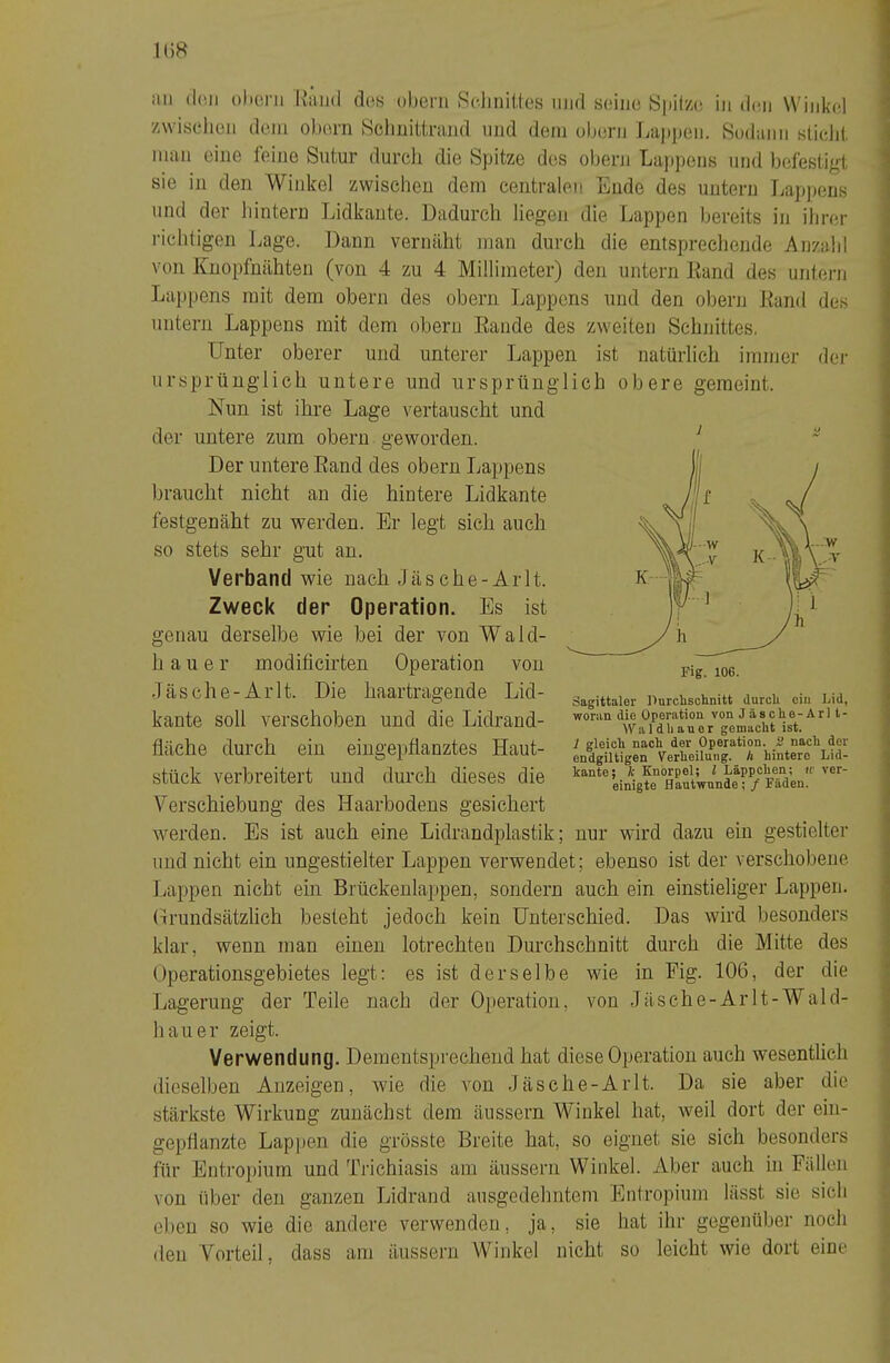 an (1(111 olioni l\’iiii(l (3os obeni ScJiiiilies iiiid soiiio !S|)ily.(; in ilcii Winkel '/\viöcli(3n (lein obeni Sclmittnind und dem obern Ijappen. Sodann kUcIiI. man eine feine Siitur durch die Spitze des obern Laiipens und befestigt sie in den Winkel zwischen dem centralen Ende des untern Lappens und der hintern Lidkante. Dadurch liegen die Lappen bereits in ihrer richtigen i.age. Dann vernäht man durch die entsprechende Anzahl von Knopfnähten (von 4 zu 4 Millimeter) den untern Kand des untern Lappens mit dem obern des obern Lappens und den obern Kami des untern Lappens mit dem obern Bande des zweiten Schnittes. Unter oberer und unterer Lappen ist natürlich immer der ursprünglich untere und ursprünglich obere gemeint. Nun ist ihre Lage vertauscht und der untere zum obern geworden. Der untere Band des obern Lappens braucht nicht an die hintere Lidkante festgenäht zu werden. Er legt sich auch so stets sehr gut an. Verband wie nach Jäsche-Arlt. Zweck der Operation. Es ist genau derselbe wie bei der von Wald- haue r modificirten Operation von ■Täsche-Arlt. Die haartragende Lid- kante soll verschoben und die Lidrand- fläche durch ein eiugepflanztes Haut- stück verbreitert und durch dieses die Verschiebung des Haarbodens gesichert werden. Es ist auch eine Lidrandplastik; nur wird dazu ein gestielter und nicht ein ungestielter Lappen verwendet; ebenso ist der verschobene Lappen nicht ein Brückenlappen, sondern auch ein einstieliger Lappen. (L’undsätzlioh besteht jedoch kein Unterschied. Das wird besonders klar, wenn man einen lotrechten Durchschnitt durch die Mitte des Operationsgebietes legt: es ist derselbe wie in Pig. 106, der die Lagerung der Teile nach der Operation, von Jäsehe-Arlt-Wald- hauer zeigt. Verwendung. Dementsprechend hat diese Operation auch wesentlich dieselben Anzeigen, wie die von Jäsche-Arlt. Da sie aber die stärkste Wirkung zunächst dem äussern Winkel hat, weil dort der ein- geplianzte Lappen die grösste Breite hat, so eignet sie sich besonders für Entropium und Trichiasis am äussern Winkel. Aber auch in Fällen von über den ganzen Lidrand ausgedehntem Entropium lässt sie sich eben so wie die andere verwenden, ja, sie hat ihr gegenüber noch den Vorteil, dass am äussern Winkel nicht so leicht wie dort eine j Sagittaler Uurclischnitt durch ein Lid, woran die Operation von J ä s che-Arl t- \V a 1 d h a u e r gemacht ist. 1 gleich nach der Operation, nach der endgiltigen Verheilung, h hintere Lid- kante; Ic Knorpel; l Läppchen; ic ver- einigte Hautwunde; / Fäden.