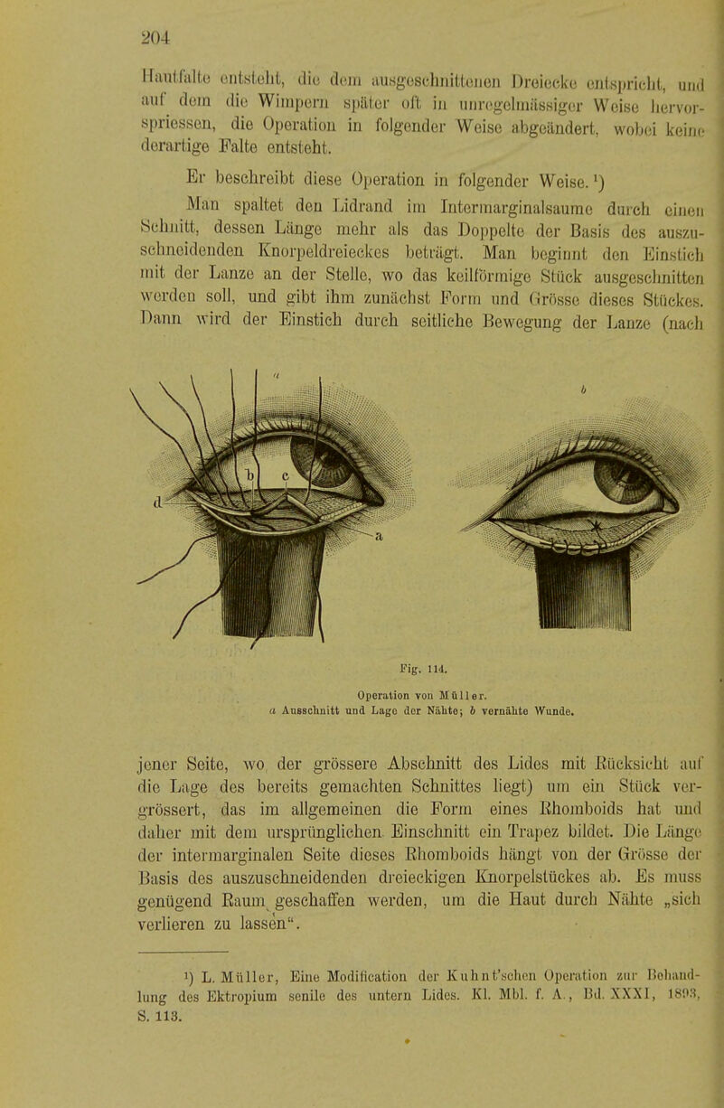 spriessen, die Operation in folgender Weise abgeändert, wobei keine derartige Falte entsteht. Er beschreibt diese Operation in folgender Weise. Man spaltet den lädrand iin Interinarginalsaume durch einen bchnitt, dessen Länge mehr als das Doppelte der Basis des auszu- sehneidenden Knorpeldreieckes beträgt. Man beginnt den Einstich mit der Lanze an der Stelle, wo das keilförmige Stück ausgeschnitten worden soll, und gibt ihm zunächst Form und Grösse dieses Stückes. Dann wird der Einstich durch seitliche Bewegung der Lanze (nach jener Seite, wo der grössere Abschnitt des Lides mit Eücksicht auf die Lage des bereits gemachten Schnittes liegt) um ein Stück ver- grössert, das im allgemeinen die Form eines Ehomboids hat und daher mit dem ursprünglichen Einschnitt ein Trapez bildet. Die Länge der intermarginalen Seite dieses Ehomboids hängt von der Grösse der Basis des auszuschneidenden dreieckigen Knorpelslückes ab. Es muss genügend Eaum geschaffen werden, um die Haut durch Nähte „sich verlieren zu lassen“. 1) L. Müller, Eine Modification der Kuhnt’sclicn Operation zur noliand- lung des Ektroinum senile des untern Lides. Kl. Mbl. f. A., 13d. XXXI, 1803, S. 113. Fig. lld. Operation von Müller. a Ansscliuitt und Lago der Nälite; & vernälite Wunde.