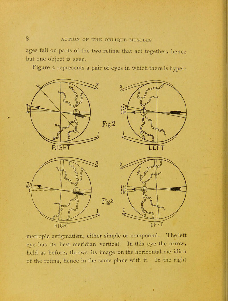 ages fall on parts of the two retinas that act together, hence but one object is seen. Figure 2 represents a pair of eyes in which there is hyper- Fig.2 RIGHT LEFT RIGHT LEFT metropic astigmatism, either simple or compound- The left eye has its best meridian vertical. In this eye the arrow, held as before, throws its image on the horizontal meridian of the retina, hence in the same plane with it. In the right 1
