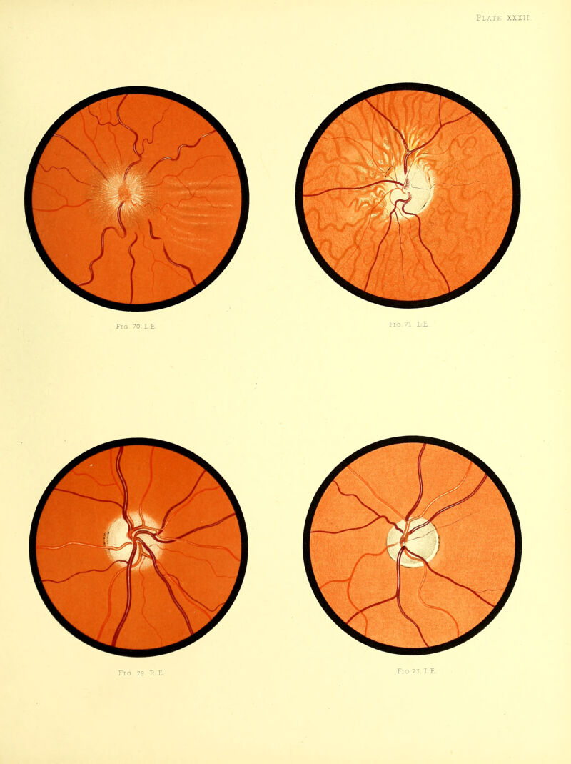 FlG^ 72. R E Fig.73. L.E