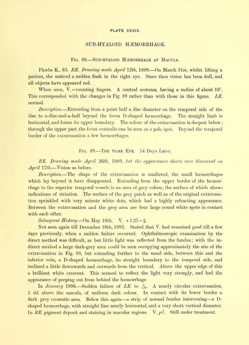 SUB-HYALOID HEMORRHAGE. Fig. 88.—Sub-hyaloid Hemorrhage at Macula. Phoebe K., 63. RE. Drawing made April 12th, 1889.—On March 31st, whilst lifting a patient, she noticed a sudden Hash in the right eye. Since then vision has been dull, and all objects have appeared red. When seen, V. = counting fingers. A central scotoma, having a radius of about 10°. This corresponded with the changes in Fig. 89 rather than with those in this figure. LE. normal. Description.—Extending from a point half a disc diameter on the temporal side of the disc to a-disc-and-a-half beyond the fovea D-shaped hfemorrhage. The straight limb is horizontal, and forms its upper boundary. The colour of the extravasation is deepest below ; through the upper part the fovea centralis can be seen as a pale spot. Beyond the temporal border of the extravasation a few ha'morrhages. Fig. 89.—The Same Eye. 14 Days Later. BE. Draiving made April 26th, 1889, but the apjicaranees shown vjere discovered on April 17th.—Vision as before. Description.—The shape of the extravasation is unaltered, the small htemorrhages which lay beyond it have disappeared. Extending from the upper border of the haanor- I'hage to the superior temporal vessels is an area of grey colour, the surface of wliicli shows indications of striation. The surface of the grey patch as well as of the original extravasa- tion sprinkled with very minute white dots, which had a highly refracting appearance. Between the extravasation and the grey area are four large round white spots in contact with each other. Subsequent History.—On May 10th. V. +l-25 = f. Not seen again till December lOtli, 1892. Stated that V. had remained good till a few days previously, when a sudden failure occurred. Ophthalmoscopic examination by the direct method was difficult, as but little light was reflected from the fundus; with the in- direct method a large dark-grey area could be seen occupying approximately the site of the extravasation in Fig. 88, l)ut extending further to the nasal side, between this and the inferior vein, a D-shaped hfemorrhage, its straight boundary to the temporal side, and inclined a little downwards and outwards from the vertical. Above the upper edge of tliis a brilliant white crescent. This seemed to reflect the light very strongly, and had the appearance of peeping out from behind the hajmorrhage. In January 1896.—Sudden failure of LE. to :/V. A nearly circular extravasation, 3 dd. above the macula, of uniform dark colour. In contact with its lower border a dark grey cresentic area. Below this again—a strip of normal fundus intervening—a D- shaped haemorrhage, with straight line nearly horizontal, and a very short vertical diameter. In BE. pigment deposit and staining in macular regions. Y. p.l. Still under treatment.