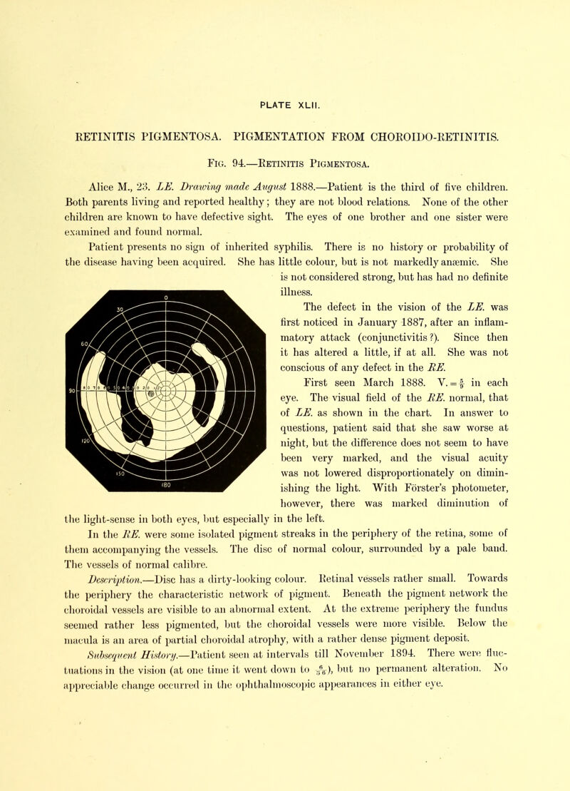 EETINITIS PIGMENTOSA. PIGMENTATION FROM CHOEOIDO-RETINITIS. Fig. 94.—Eetinitis Pigmentosa. Alice M., 23. LE. Dratvi-ng made August 1888.—Patient is the third of five children. Both parents living and reported healthy; they are not blood relations. None of the other children are known to have defective sight. The eyes of one brother and one sister were examined and found normal. Patient presents no sign of inherited syphilis. There is no history or probability of the disease having been acquired. She has little colour, but is not markedly anaemic. She is not considered strong, but has had no definite illness. The defect in the vision of the LE. was first noticed in January 1887, after an inflam- matory attack (conjunctivitis ?). Since then it has altered a little, if at all. She was not conscious of any defect in the BE. First seen March 1888. V. = f in each eye. The visual field of the EE. normal, that of ZE. as shown in the chart. In answer to questions, patient said that she saw worse at night, but the difference does not seem to have been very marked, and the visual acuity was not lowered disproportionately on dimin- ishing the light. With Forster's photometer, however, there was marked diminution of the light-sense in both eyes, Viut especially in the left. In the HE. were some isolated pigment streaks in the peripliery of the retina, some of them accompanying the vessels. The disc of normal colour, surrounded by a pale band. The vessels of normal calibre. Desr,riptio7i.—Disc has a dirty-looking colour. Retinal vessels rather small. Towards the periphery the characteristic network of pigment. Beneath the pigment network the choroidal vessels are visible to an abnormal extent. At the extreme periphery the fundus seemed rather less pigmented, but the choroidal vessels were more visible. Below the macula is an area of partial choroidal atrophy, with a rather dense pigment deposit. Sidmqi'cni History.—V'dtient seen at intervals till November 1894. There were fluc- tuations in the vision (at one time it went down to .^^), hut no permanent alteration. No appreciable change occurred in the ophthalmoscopic appearances in either e}'e.
