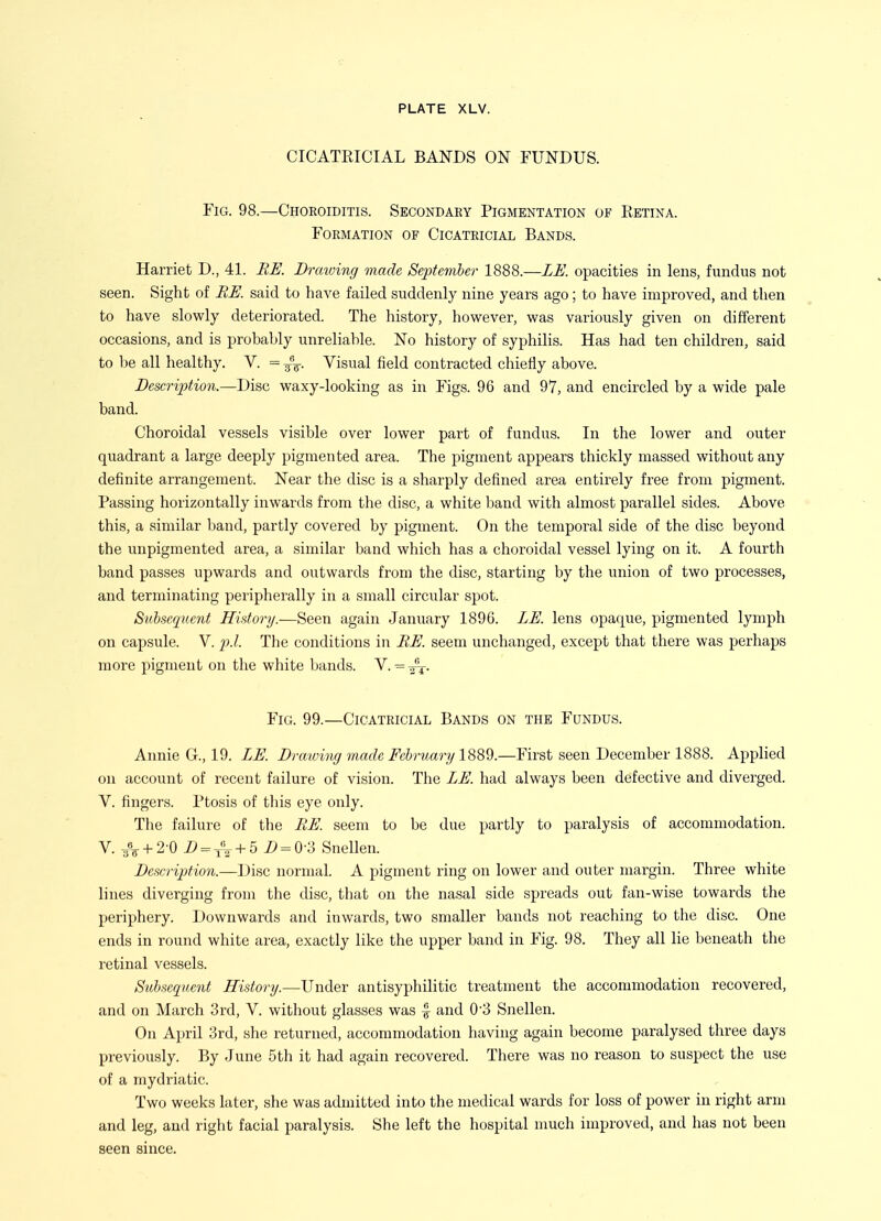 CICATEICIAL BANDS ON FUNDUS. Fig. 98.—Choroiditis. Secondary Pigmentation of Kbtina. Formation of Cicatricial Bands. Harriet D., 41. UK Draiuing made September 1888.—LE. opacities in lens, fundus not seen. Sight of BE. said to have failed suddenly nine years ago; to have improved, and then to have slowly deteriorated. The history, however, was variously given on different occasions, and is probably unreliable. No history of syphihs. Has had ten children, said to be all healthy. V. = Visual field contracted chiefly above. Description.—Disc waxy-looking as in Figs. 96 and 97, and encircled by a wide pale band. Choroidal vessels visible over lower part of fundus. In the lower and outer quadrant a large deeply pigmented area. The pigment appears thickly massed without any definite arrangement. Near the disc is a sharply defined area entirely free from pigment. Passing horizontally inwards from the disc, a white band with almost parallel sides. Above this, a similar band, partly covered by pigment. On the temporal side of the disc beyond the unpigmented area, a similar band which has a choroidal vessel lying on it. A fourth band passes upwards and outwards from the disc, starting by the union of two processes, and terminating peripherally in a small circular spot. Subsequent History.—Seen again January 1896. LE. lens opaque, pigmented lymph on capsule. V. 2^.1. The conditions in BE. seem unchanged, except that there was perhaps more pigment on the white bands. V. = 2^- Fig. 99.—Cicatricial Bands on the Fundus. Annie G., 19. LE. Draiving inade Febmary 1889.—First seen December 1888. Applied on account of recent failure of vision. The LE. had always been defective and diverged. V. fingers. Ptosis of this eye only. The failure of the ME. seem to be due partly to paralysis of accommodation. V. ^\ + 2-0 i> = + 5 i> = 0-3 Snellen. Description.—Disc normal. A pigment ring on lower and outer margin. Three white lines diverging from the disc, that on the nasal side spreads out fan-wise towards the periphery. Downwards and inwards, two smaller bands not reaching to the disc. One ends in round white area, exactly like the upper band in Fig. 98. They all he beneath the retinal vessels. Subsequent History.—Under antisyphilitic treatment the accommodation recovered, and on March 3rd, V. without glasses was ^ and 03 Snellen. On April 3rd, she returned, accommodation having again become paralysed three days previously. By June 5th it had again recovered. There was no reason to suspect the use of a mydriatic. Two weeks later, she was admitted into the medical wards for loss of power in right arm and leg, and right facial paralysis. She left the hospital nauch improved, and has not been seen since.