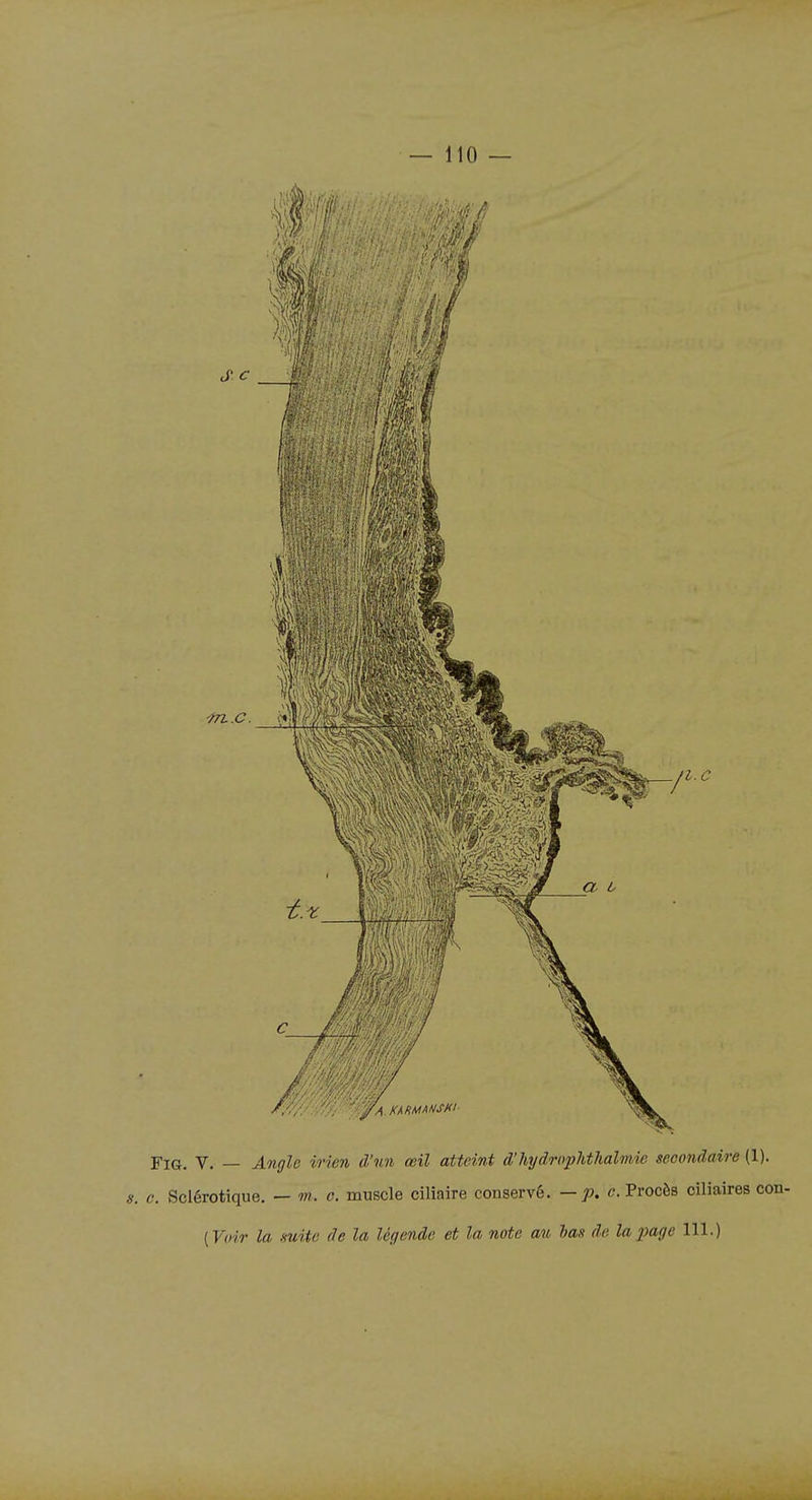 FiG. V. — Angle irien d'un œil atteint d'hydrophthalmie secondaire (1). s. e. Sclérotique. — m. c. muscle ciliaire conservé, — p. c. Procès ciliaires con- [Voir la suite de la légende et la note au has de. la page 111.)