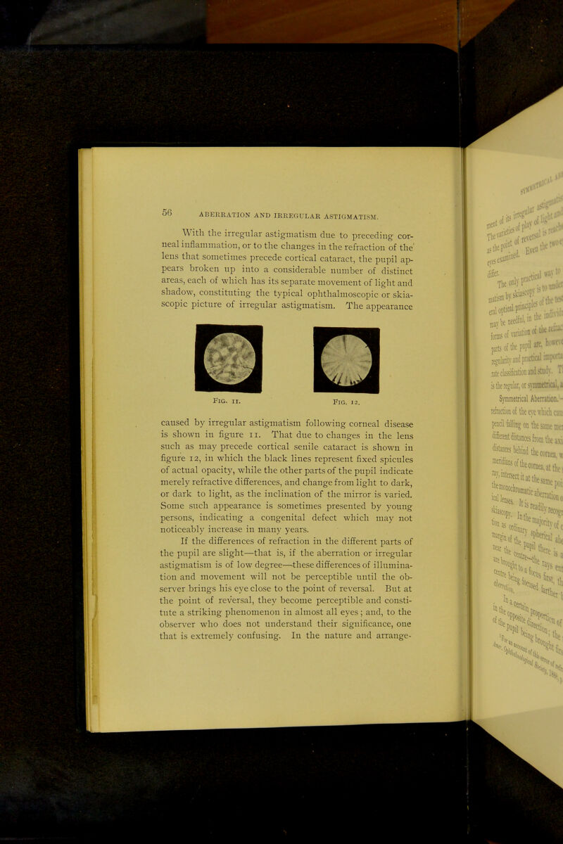 With the irregular astigmatism due to preceding cor- neal inflammation, or to the changes in the refraction of the' lens that sometimes precede cortical cataract, the pupil ap- pears broken up into a considerable number of distinct areas, each of which has its separate movement of light and shadow, constituting the typical ophthalmoscopic or skia- scopic picture of irregular astigmatism. The appearance Fig. II. Fig. 12. caused by irregular astigmatism following corneal disease is shown in figure 11. That due to changes in the lens such as may precede cortical senile cataract is shown in figure 12, in which the black lines represent fixed spicules of actual opacity, while the other parts of the pupil indicate merely refractive differences, and change from light to dark, or dark to light, as the inclination of the mirror is varied. Some such appearance is sometimes presented by young persons, indicating a congenital defect which may not noticeably increase in many years. If the differences of refraction in the different parts of the pupil are slight—that is, if the aberration or irregular astigmatism is of low degree—these differences of illumina- tion and movement will not be perceptible until the ob- server brings his eye close to the point of reversal. But at the point of reversal, they become perceptible and consti- tute a striking phenomenon in almost all eyes ; and, to the observer who does not understand their significance, one that is extremely confusing. In the nature and arrange-