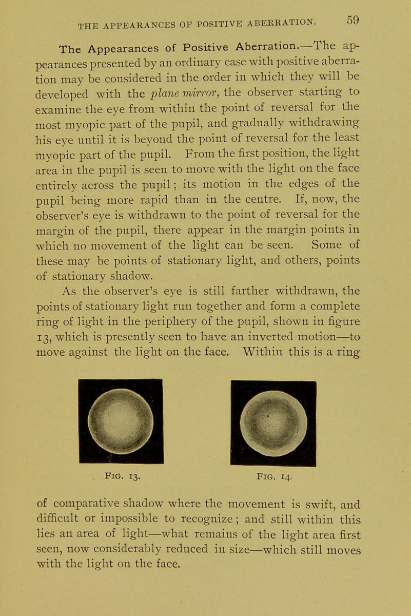 The Appearances of Positive Aberration.—The ap- pearances presented by an ordinary case with positive aberra- tion may be considered in the order in which they will be developed with the plane mirror, the observer starting to examine the eye from within the point of reversal for the most myopic part of the pupil, and gradually withdrawing his eye until it is beyond the point of reversal for the least myopic part of the pupil. From the first position, the light area in the pupil is seen to move with the light on the face entirely across the pupil; its motion in the edges of the pupil being more rapid than in the centre. If, now, the observer's eye is withdrawn to the point of reversal for the margin of the pupil, there appear in the margin points in which no movement of the light can be seen. Some of these may be points of stationary light, and others, points of stationary shadow. As the observer's eye is still farther withdrawn, the points of stationary light run together and form a complete ring of light in the periphery of the pupil, shown in figure 13, which is presently seen to have an inverted motion—to move against the light on the face. Within this is a ring Fig. 13. Fig. 14. of comparative shadow where the movement is swift, and difiicult or impossible to recognize; and still within this lies an area of light—what remains of the light area first seen, now considerably reduced in size—which still moves with the light on the face.