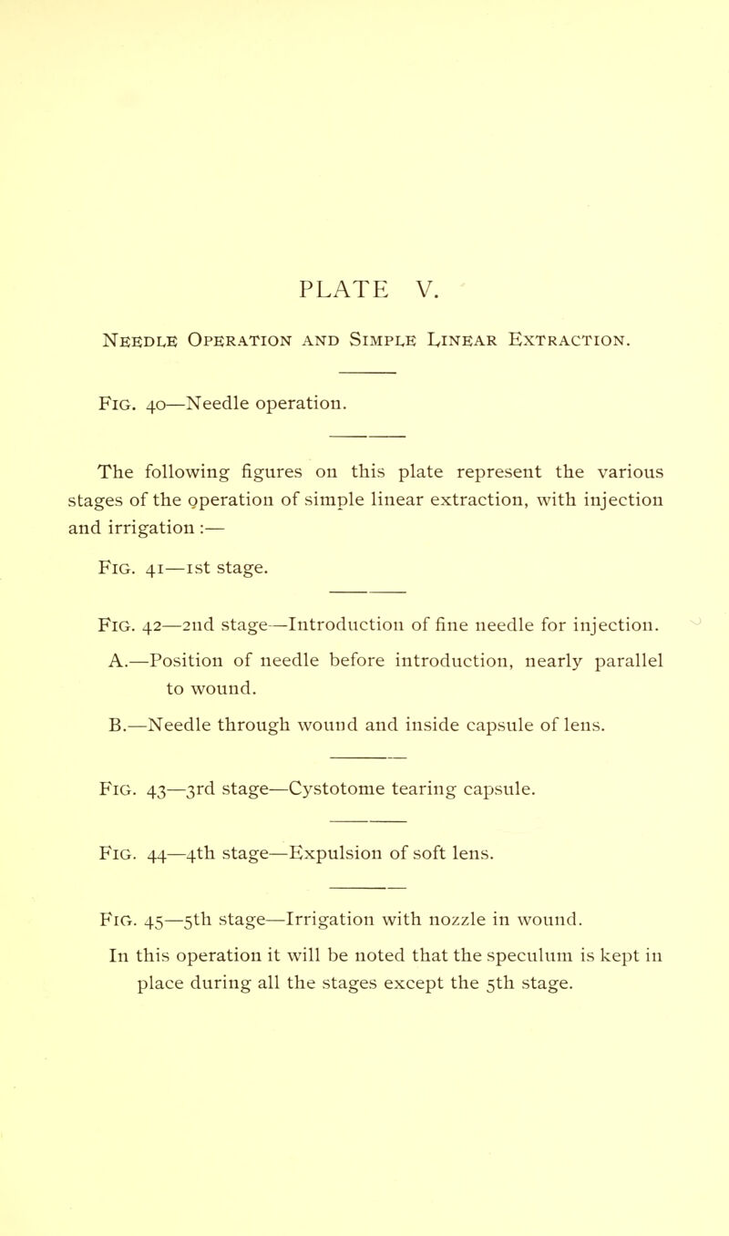 Needle Operation and Simple Linear Extraction. Fig. 40—Needle operation. The following figures on this plate represent the various stages of the operation of simple linear extraction, with injection and irrigation:— Fig. 41—1st stage. Fig. 42—2nd stage—Introduction of fine needle for injection. A. —Position of needle before introduction, nearly parallel to wound. B. —Needle through wound and inside capsule of lens. Fig. 43—3rd stage—Cystotome tearing capsule. Fig. 44—4th stage—Expulsion of soft lens. Fig. 45—5th stage—Irrigation with nozzle in wound. In this operation it will be noted that the speculum is kept in place during all the stages except the 5th stage.