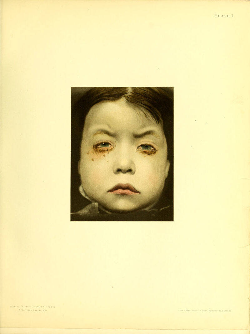 ATLAS OF ExTEBIIAl DISEASES Of THE Cvt A Maitlanu Ramsav, W D James MacLehose s. Sons, Publishers, Glasgow