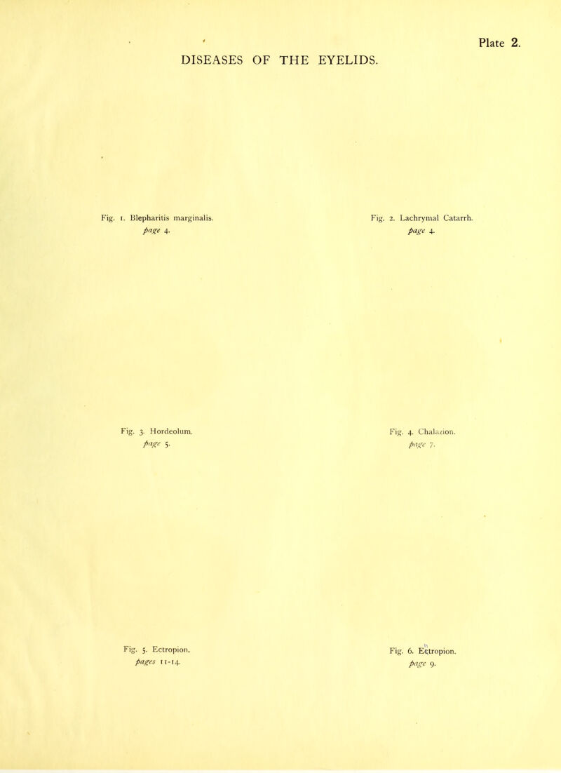 Fig. I. Blepharitis marginalis. Fig. 2. Lachrymal Catarrh. pn^e 4. page 4. Fig. 3. Hordeolum. Fig. 4. Chahuion. page 5. page 7. Fig. 5. Ectropion. Fig. 6. E(S;tropion.