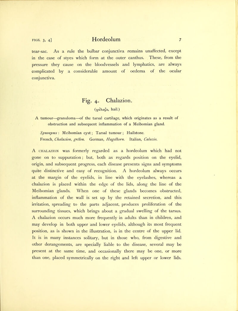 tear-sac. As a rule the bulbar conjunctiva remains unaffected, except in the case of styes which form at the outer canthus. These, from the pressure they cause on the bloodvessels and lymphatics, are always complicated by a considerable amount of oedema of the ocular conjunctiva. Fig. 4. Chalazion. (xaXa^a, hail.) A tumour—granuloma—of the tarsal cartilage, which originates as a result of obstruction and subsequent inflammation of a Meibomian gland. Synonyms : Meibomian cyst; Tarsal tumour ; Hailstone. French, Chalazion, grelon. German, Hagelkorn. Italian, Calazio, A CHALAZION was formerly regarded as a hordeolum which had not gone on to suppuration; but, both as regards position on the eyelid, origin, and subsequent progress, each disease presents signs and symptoms quite distinctive and easy of recognition. A hordeolum always occurs at the margin of the eyelids, in line with the eyelashes, whereas a chalazion is placed within the edge of the lids, along the line of the Meibomian glands. When one of these glands becomes obstructed, inflammation of the wall is set up by the retained secretion, and this irritation, spreading to the parts adjacent, produces proliferation of the surrounding tissues, which brings about a gradual swelling of the tarsus. A chalazion occurs much more frequently in adults than in children, and may develop in both upper and lower eyelids, although its most frequent position, as is shown in the illustration, is in the centre of the upper lid. It is in many instances solitary, but in those who, from digestive and other derangements, are specially liable to the disease, several may be present at the same time, and occasionally there may be one, or more than one, placed symmetrically on the right and left upper or lower lids.
