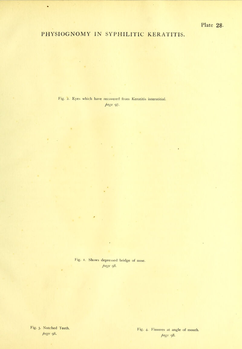 PHYSIOGNOMY IN SYPHILITIC KERATITIS. Fig. 2. Eyes which have recovered from Keratitis interstitial. page 97. Fig. I. Shows depressed bridge of nose. page 98. Fig. 3. Notched Teeth. ■page 98. Fig. 4. Fissures at angle of mouth. page 98.