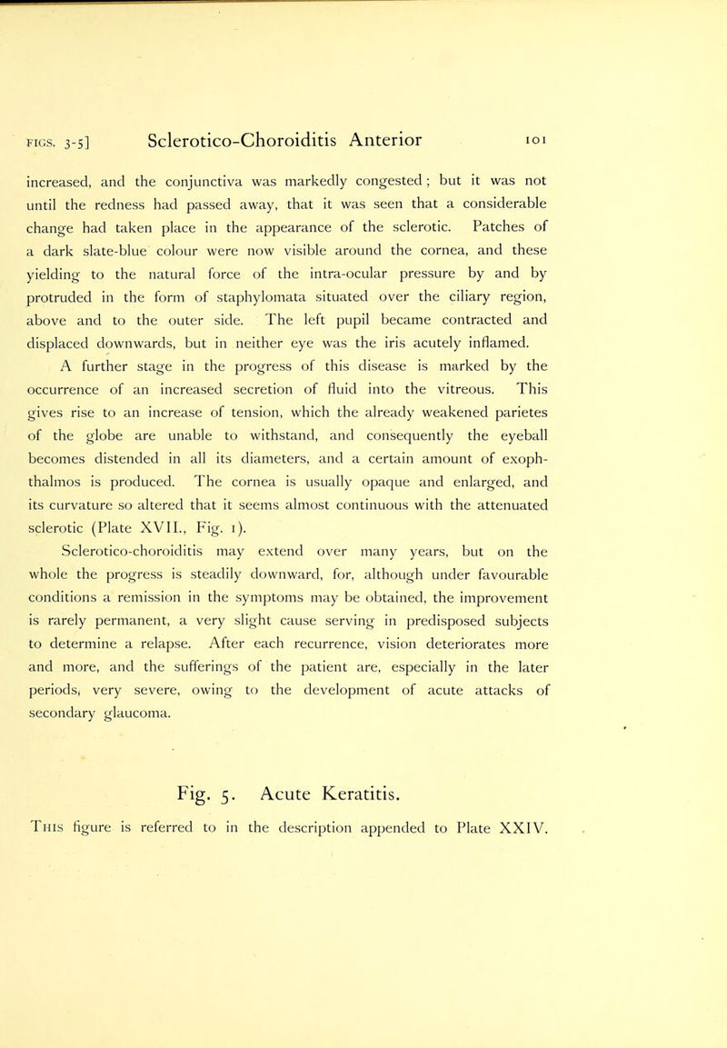 FIGS. 3-5] Sclerotico-Choroiditis Anterior lOI increased, and the conjunctiva was markedly congested ; but it was not until the redness had passed away, that it was seen that a considerable change had taken place in the appearance of the sclerotic. Patches of a dark slate-blue colour were now visible around the cornea, and these yielding to the natural force of the intra-ocular pressure by and by protruded in the form of staphylomata situated over the ciliary region, above and to the outer side. The left pupil became contracted and displaced downwards, but in neither eye was the iris acutely inflamed. A further stage in the progress of this disease is marked by the occurrence of an increased secretion of fluid into the vitreous. This gives rise to an increase of tension, which the already weakened parietes of the globe are unable to withstand, and consequently the eyeball becomes distended in all its diameters, and a certain amount of exoph- thalmos is produced. The cornea is usually opaque and enlarged, and its curvature so altered that it seems almost continuous with the attenuated sclerotic (Plate XVII., Fig. i). Sclerotico-choroiditis may extend over many years, but on the whole the progress is steadily downward, for, although under favourable conditions a remission in the symptoms may be obtained, the improvement is rarely permanent, a very slight cause serving in predisposed subjects to determine a relapse. After each recurrence, vision deteriorates more and more, and the sufferings of the patient are, especially in the later periods^ very severe, owing to the development of acute attacks of secondary glaucoma. Fig. 5. Acute Keratitis.