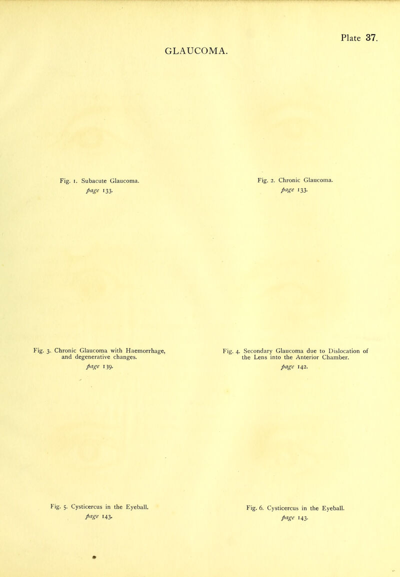 Fig. I. Subacute Glaucoma. page 133- Fig. 2. Chronic Glaucoma. page 133. Fig. 3. Chronic Glaucoma with Haemorrhage, and degenerative changes. page 139. Secondary Glaucoma due to Dislocation of the Lens into the Anterior Chamber. page 142. Fig. 5. Cysticercus in the Eyeball. page 143- Fig. 6. Cysticercus in the Eyeball. page 143.