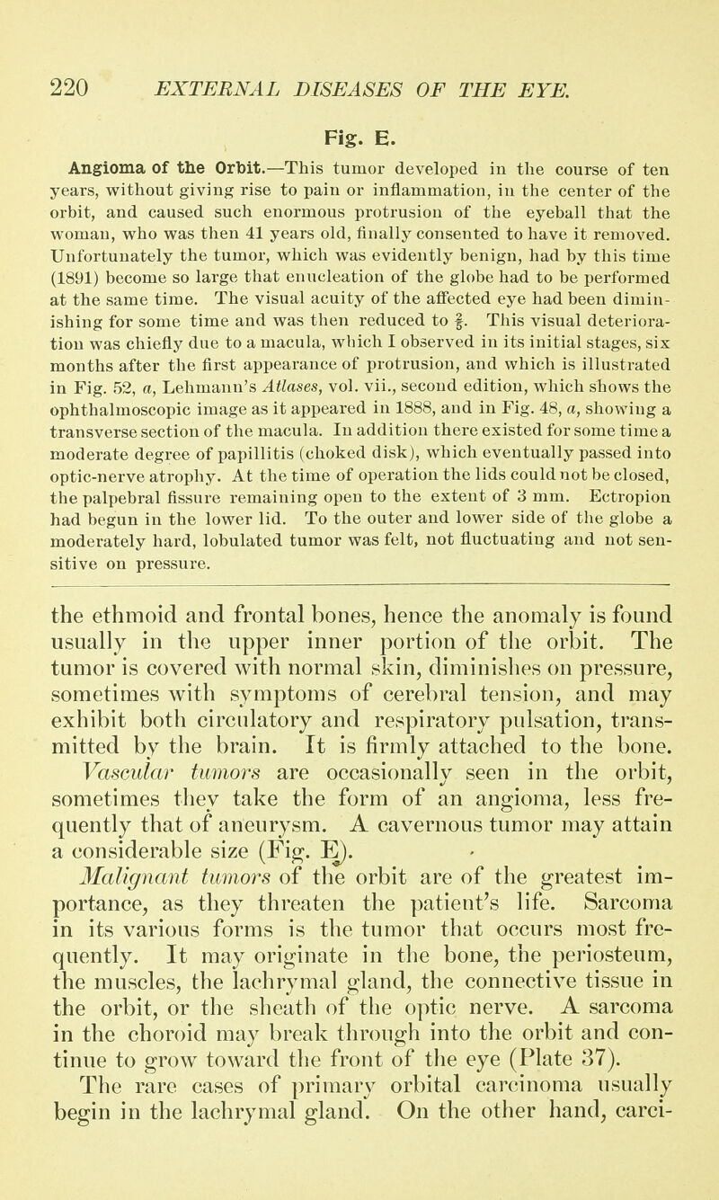 Fig. E. Angioma of the Orbit.—This tumor developed in the course of ten years, without giving rise to pain or inflammation, in the center of the orbit, and caused such enormous protrusion of the eyeball that the woman, who was then 41 years old, finally consented to have it removed. Unfortunately the tumor, which was evidently benign, had by this time (1891) become so large that enucleation of the globe had to be performed at the same time. The visual acuity of the affected eye had been dimin- ishing for some time and was then reduced to f. This visual deteriora- tion was chiefly due to a macula, which I observed in its initial stages, six months after the first appearance of protrusion, and which is illustrated in Fig. 52, a, Lehmann's Atlases, vol. vii., second edition, which shows the ophthalmoscopic image as it appeared in 1888, and in Fig. 48, a, showing a transverse section of the macula. In addition there existed for some time a moderate degree of papillitis (choked disk), which eventually passed into optic-nerve atrophy. At the time of operation the lids could not be closed, the palpebral fissure remaining open to the extent of 3 mm. Ectropion had begun in the lower lid. To the outer and lower side of the globe a moderately hard, lobulated tumor was felt, not fluctuating and not sen- sitive on pressure. the ethmoid and frontal bones, hence the anomaly is found usually in the upper inner portion of the orbit. The tumor is covered with normal skin, diminishes on pressure, sometimes with symptoms of cerebral tension, and may exhibit both circulatory and respiratory pulsation, trans- mitted by the brain. It is firmly attached to the bone. Vascular tumors are occasionally seen in the orbit, sometimes they take the form of an angioma, less fre- quently that of aneurysm. A cavernous tumor may attain a considerable size (Fig. E). Malignant tumors of the orbit are of the greatest im- portance, as they threaten the patient's life. Sarcoma in its various forms is the tumor that occurs most fre- quently. It may originate in the bone, the periosteum, the muscles, the lachrymal gland, the connective tissue in the orbit, or the sheath of the optic nerve. A sarcoma in the choroid may break through into the orbit and con- tinue to grow toward the front of the eye (Plate 37). The rare cases of primary orbital carcinoma usually begin in the lachrymal gland. On the other hand, carci-