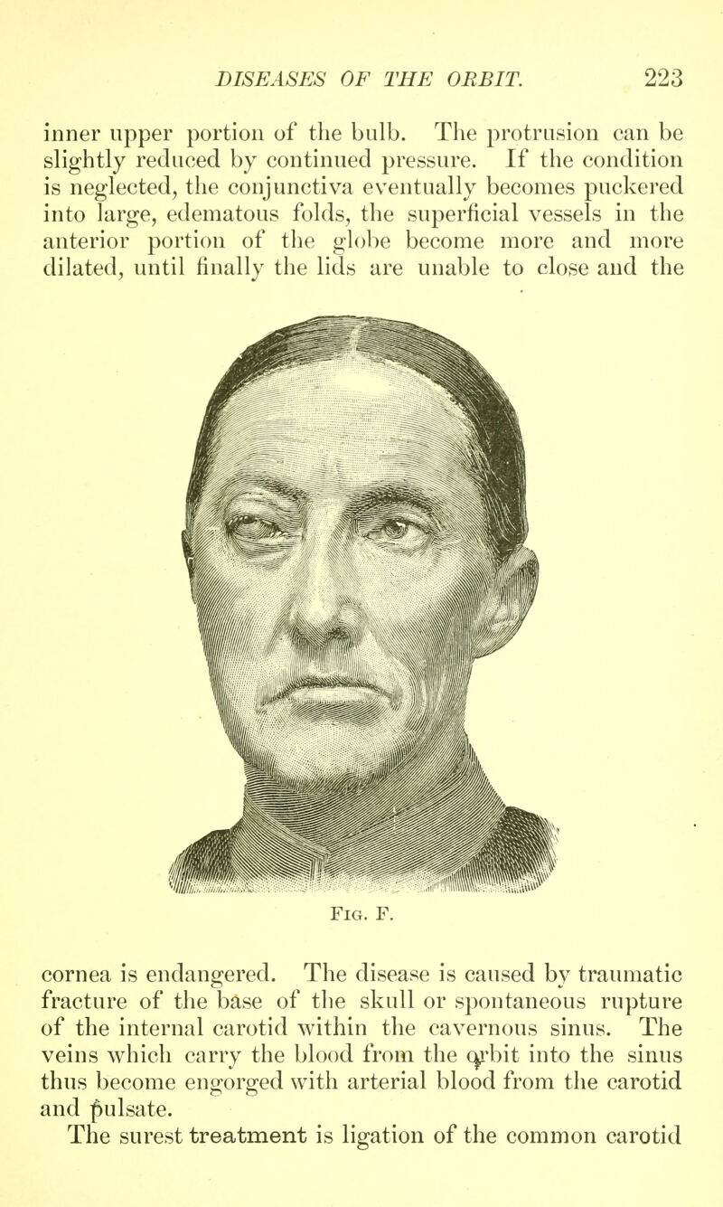 inner upper portion of the bulb. The protrusion can be slightly reduced by continued pressure. If the condition is neglected, the conjunctiva eventually becomes puckered into large, edematous folds, the superficial vessels in the anterior portion of the globe become more and more dilated, until finally the lids are unable to close and the Fig. F. cornea is endangered. The disease is caused by traumatic fracture of the base of the skull or spontaneous rupture of the internal carotid within the cavernous sinus. The veins which carry the blood from the qrbit into the sinus thus become engorged with arterial blood from the carotid and pulsate. The surest treatment is ligation of the common carotid