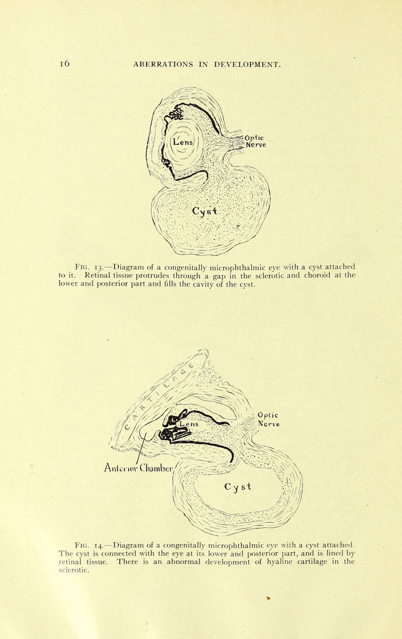 Fig. 13.—Diagram of a congenitally microphthalmic eye with a cyst attached to it. Retinal tissue protrudes through a gap in the sclerotic and choroid at the lower and posterior part and fills the cavity of the cyst. Fig. 14.—Diagram of a congenitally microphthalmic eye with a cyst attached. The cyst is connected with the eye at its lower and posterior part, and is lined by retinal tissue. There is an abnormal development of hyaline cartilage in the sclerotic.