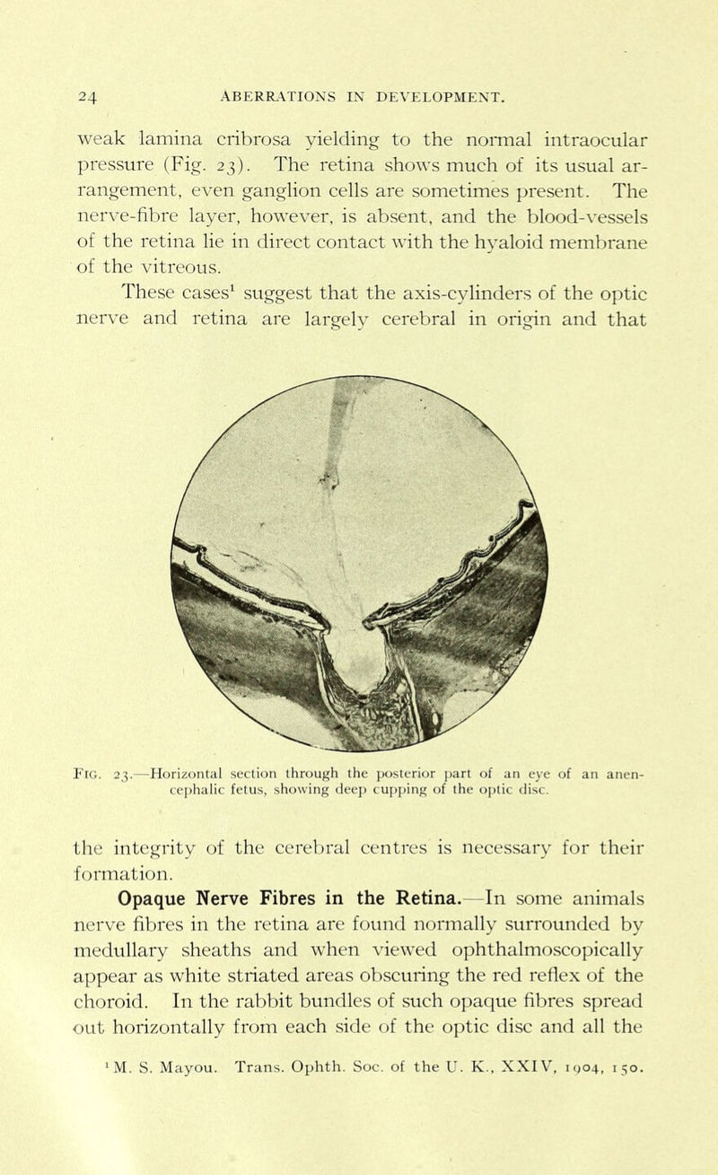 weak lamina cribrosa yielding to the normal intraocular pressure (Fig. 23). The retina shows much of its usual ar- rangement, even ganglion cells are sometimes present. The nerve-fibre layer, however, is absent, and the blood-vessels of the retina lie in direct contact with the hyaloid membrane of the vitreous. These cases^ suggest that the axis-cylinders of the optic nerve and retina are largely cerebral in origin and that Fig. 23.—Horizontal section through the posterior part of an eye of an anen- cephalic fetus, showing deep cupping of the optic disc. the integrity of the cerebral centres is necessary for their formation. Opaque Nerve Fibres in the Retina.—In some animals nerve fibres in the retina are found normally surrounded by medullary sheaths and when viewed ophthalmoscopically appear as white striated areas obscuring the red reflex of the choroid. In the rabbit bundles of such opaque fibres spread out horizontally from each side of the optic disc and all the