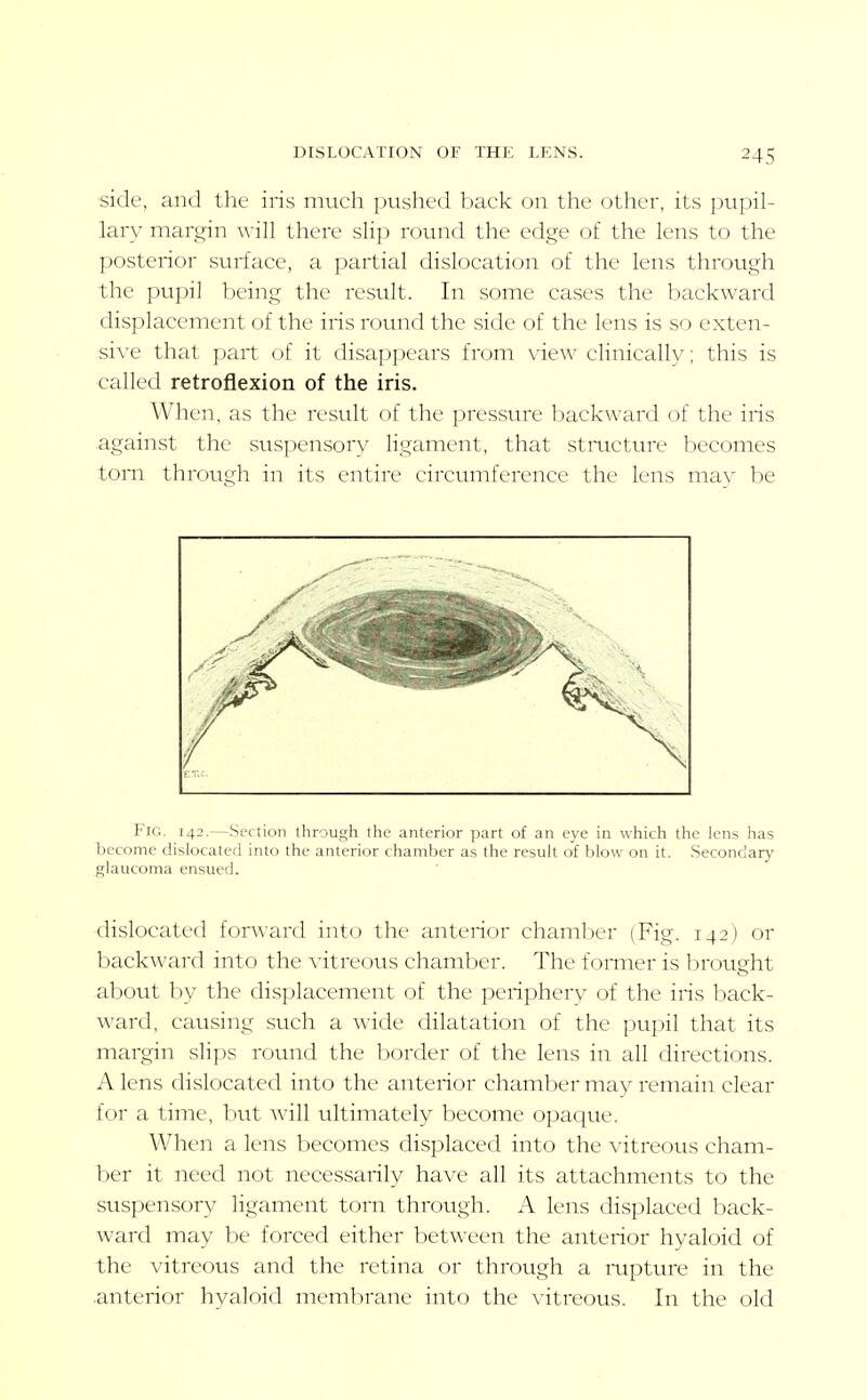 side, and the iris much pushed back on the other, its pupil- lar\- margin \^•ill there sHp roinid the edge of the lens to the posterior surface, a partial dislocation of the lens through the pvtpil being the result. In some cases the backward displacement of the iris round the side of the lens is so exten- si\'e that part of it disappears from view clinically; this is caUed retroflexion of the iris. When, as the result of the pressure backward of the iris against the suspensory ligament, that stmcture Inecomes torn through in its entire circumference the lens may be Fig. 142.—Section through the anterior part of an eye in which the lens has become dislocated into the anterior chamber as the result of blow on it. Secondary glaucoma ensued. dislocated forward into the anterior chamber (Fig. 142) or backward into the vitreous chamber. The former is brought about by the displacement of the periphery of the iris back- ward, causing such a wide dilatation of the pupil that its margin slips round the border of the lens in all directions. A lens dislocated into the anterior chamber may remain clear for a time, but will ultimately become opaque. When a lens becomes displaced into the vitreous cham- ber it need not necessarily have all its attachments to the suspensory ligament torn through. A lens displaced back- ward may be forced either between the anterior hyaloid of the vitreous and the retina or through a mpture in the .anterior hyaloid membrane into the vitreous. In the old
